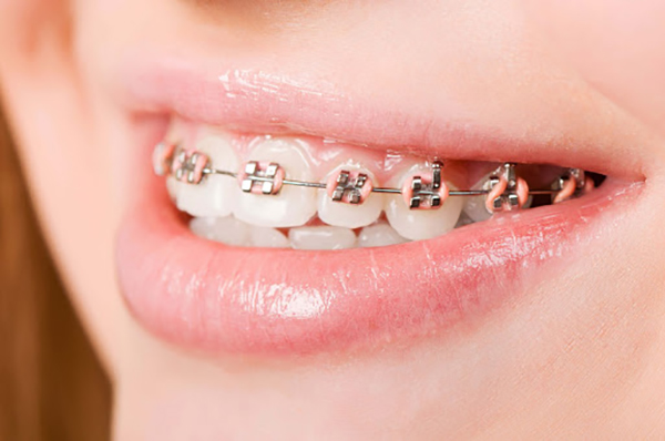 Niềng răng mắc cài tự động - Rút ngắn thời gian chỉnh nha từ 4 - 6 tháng