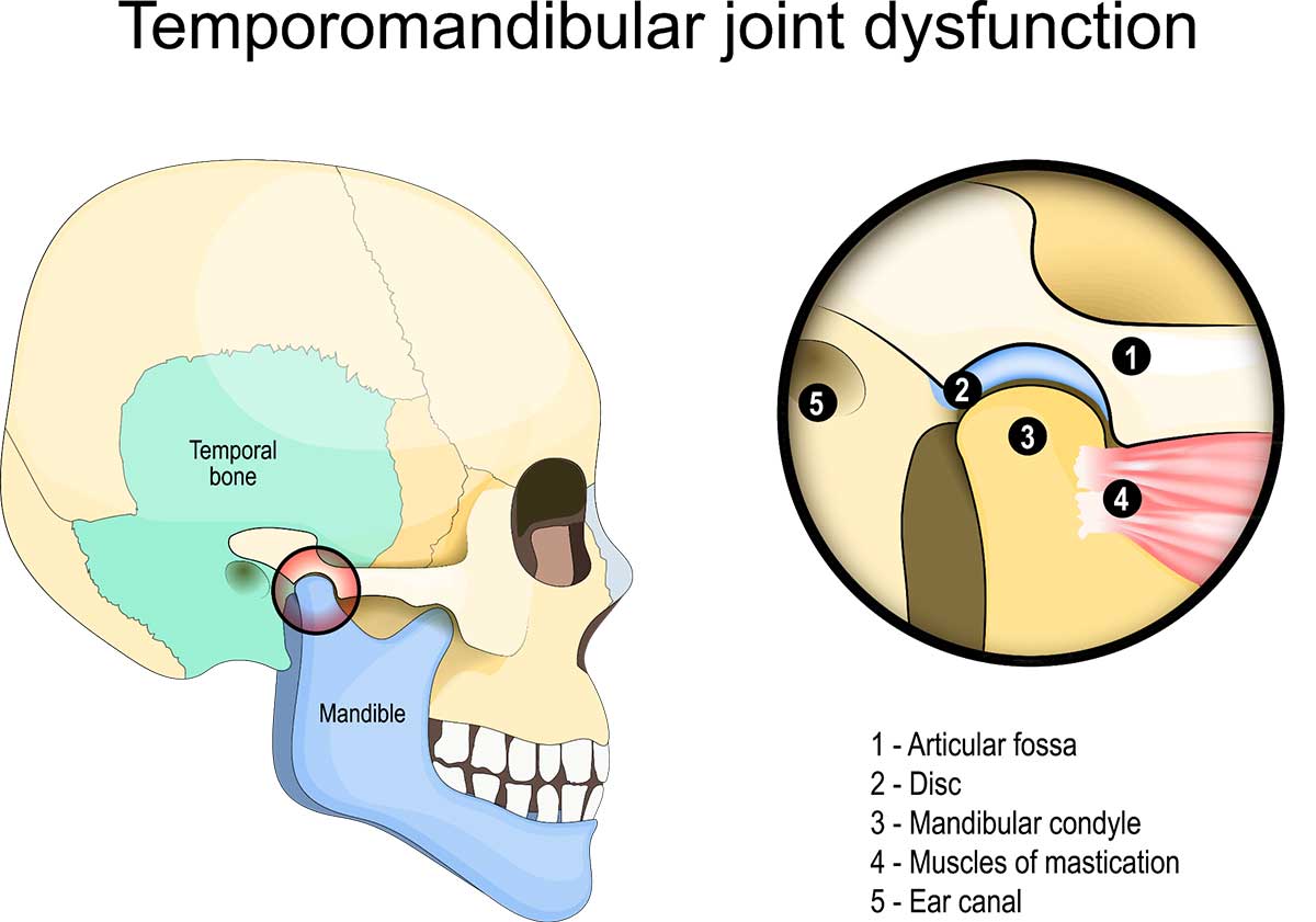 What Botox Can and Can't Fix About TMJ