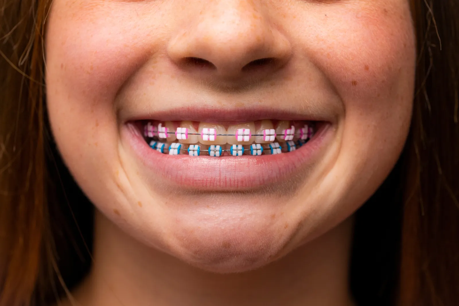 BLANCH | A close up of a person with braces on their teeth.