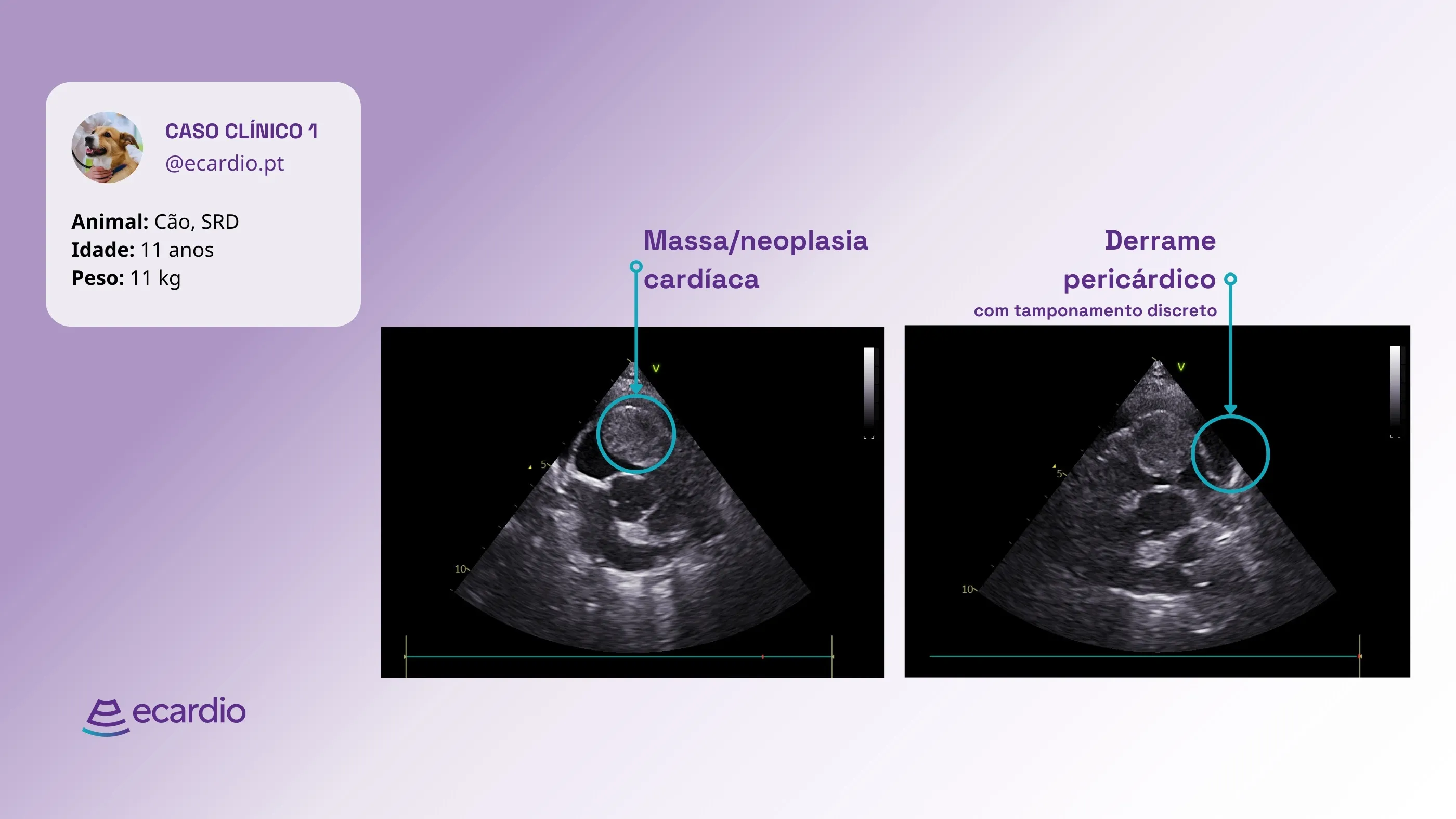 ecardio-resultados-ecocardiografia-massa-cardiaca-e-tamponamento-cardíaco
