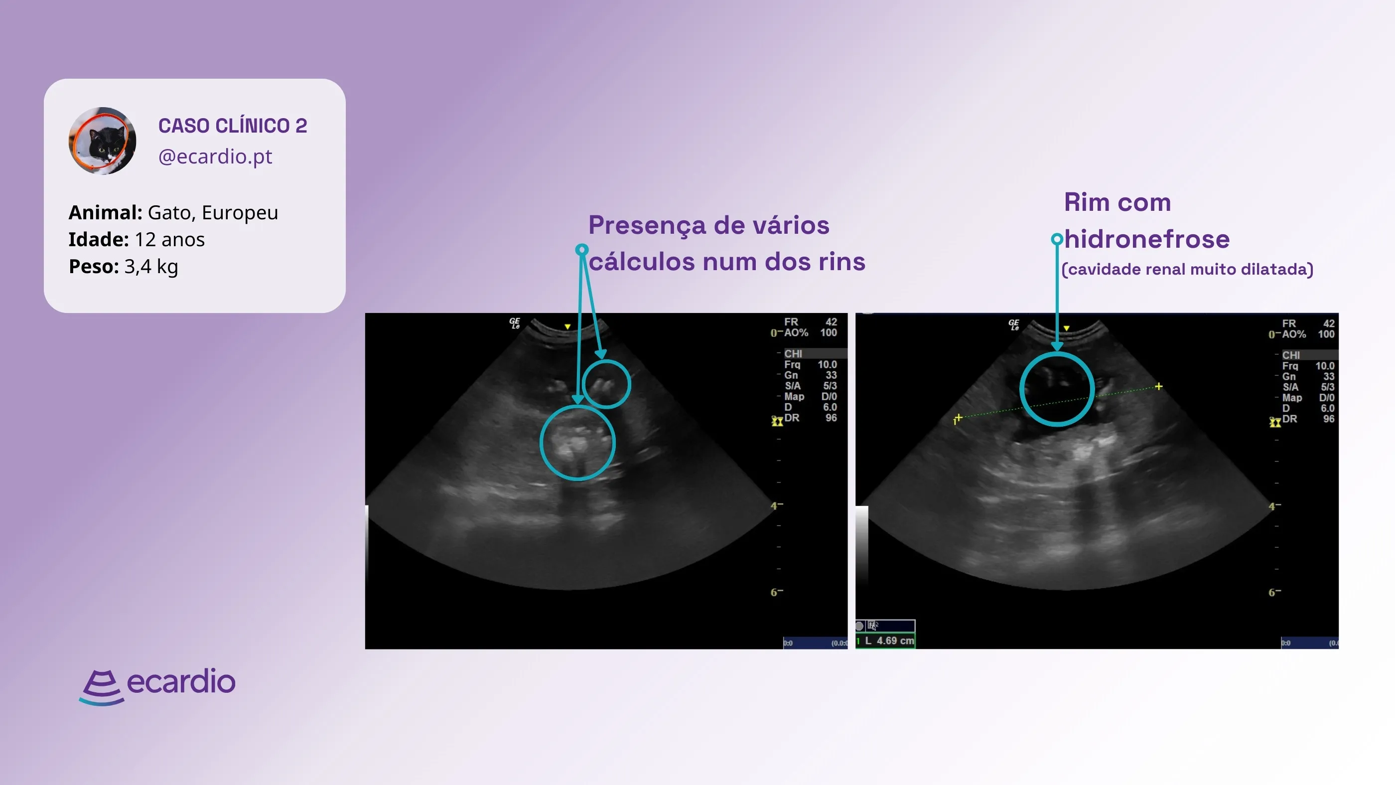 ecardio-resultados-ecografoa-abdominal-ultrassonografia-renal-hidronefrose