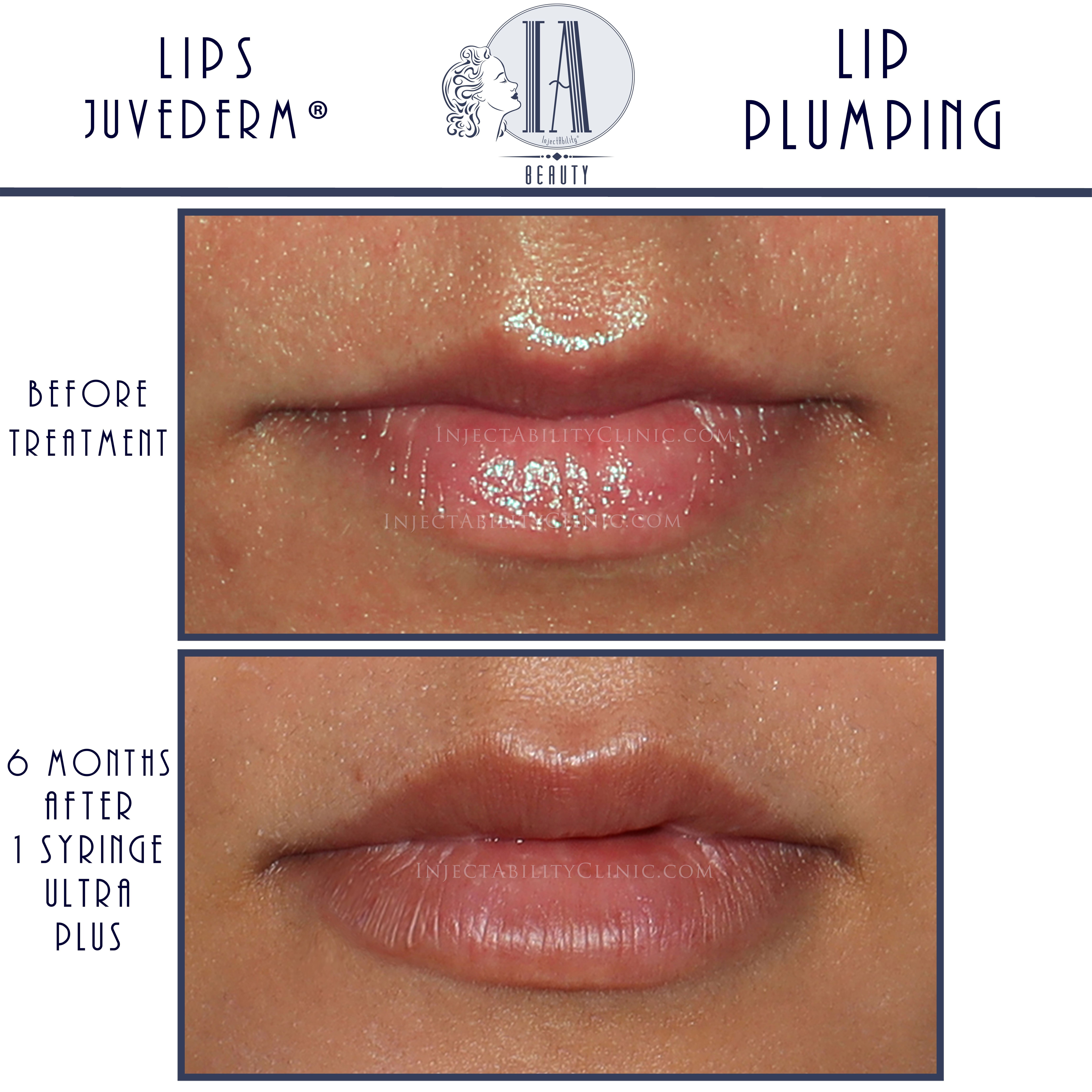 Comparison of Juvederm®   injection types for facial areas in Torrance, California