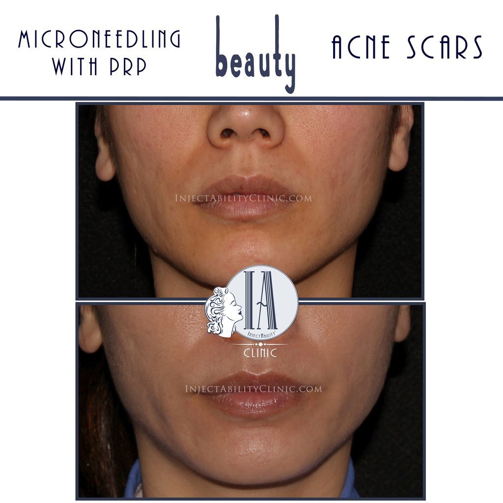 Microneedling treatment being performed on a patient's cheek at a Torrance, California aesthetic clinic