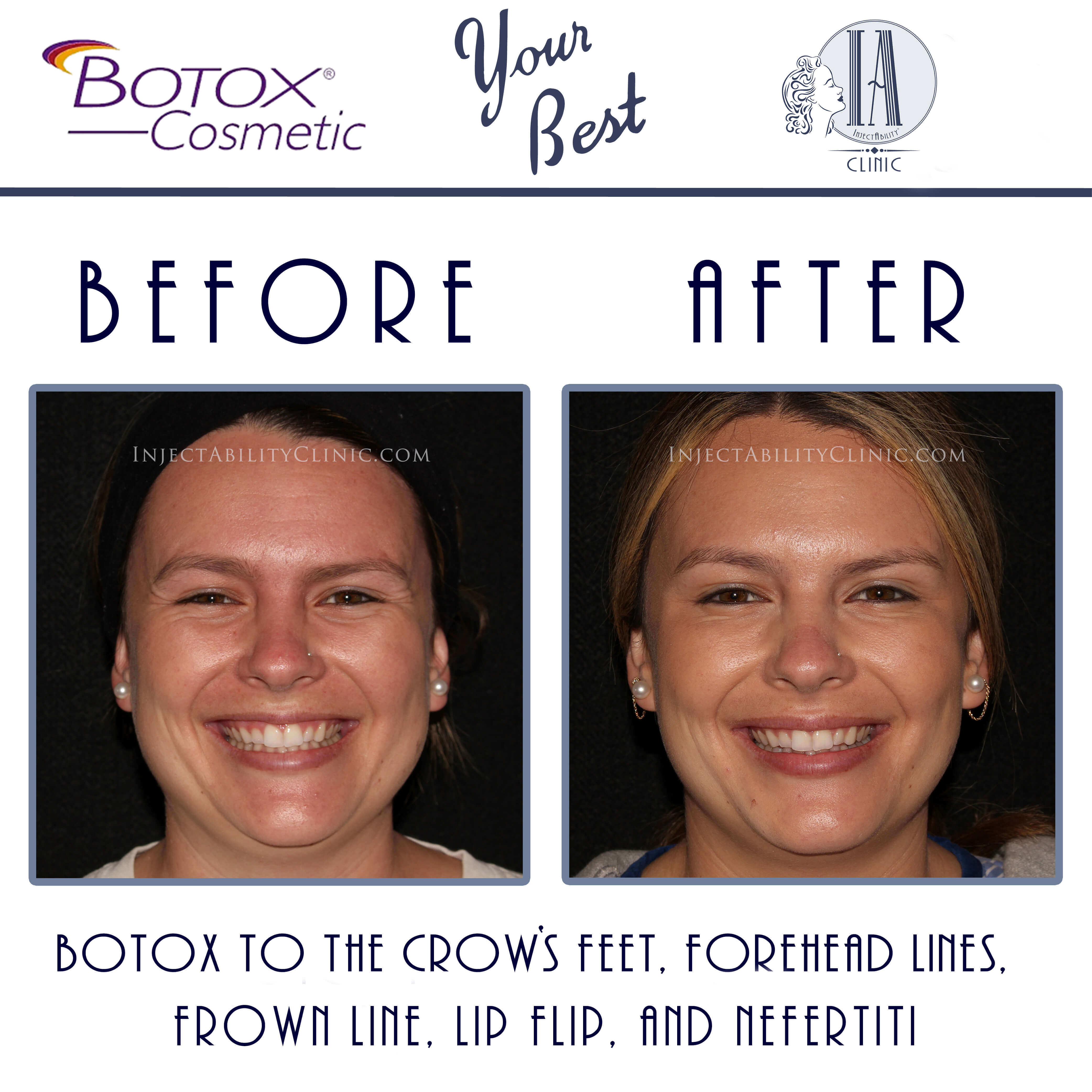  Provider administering a Botox injection to smooth forehead lines at a Torrance, California clinic