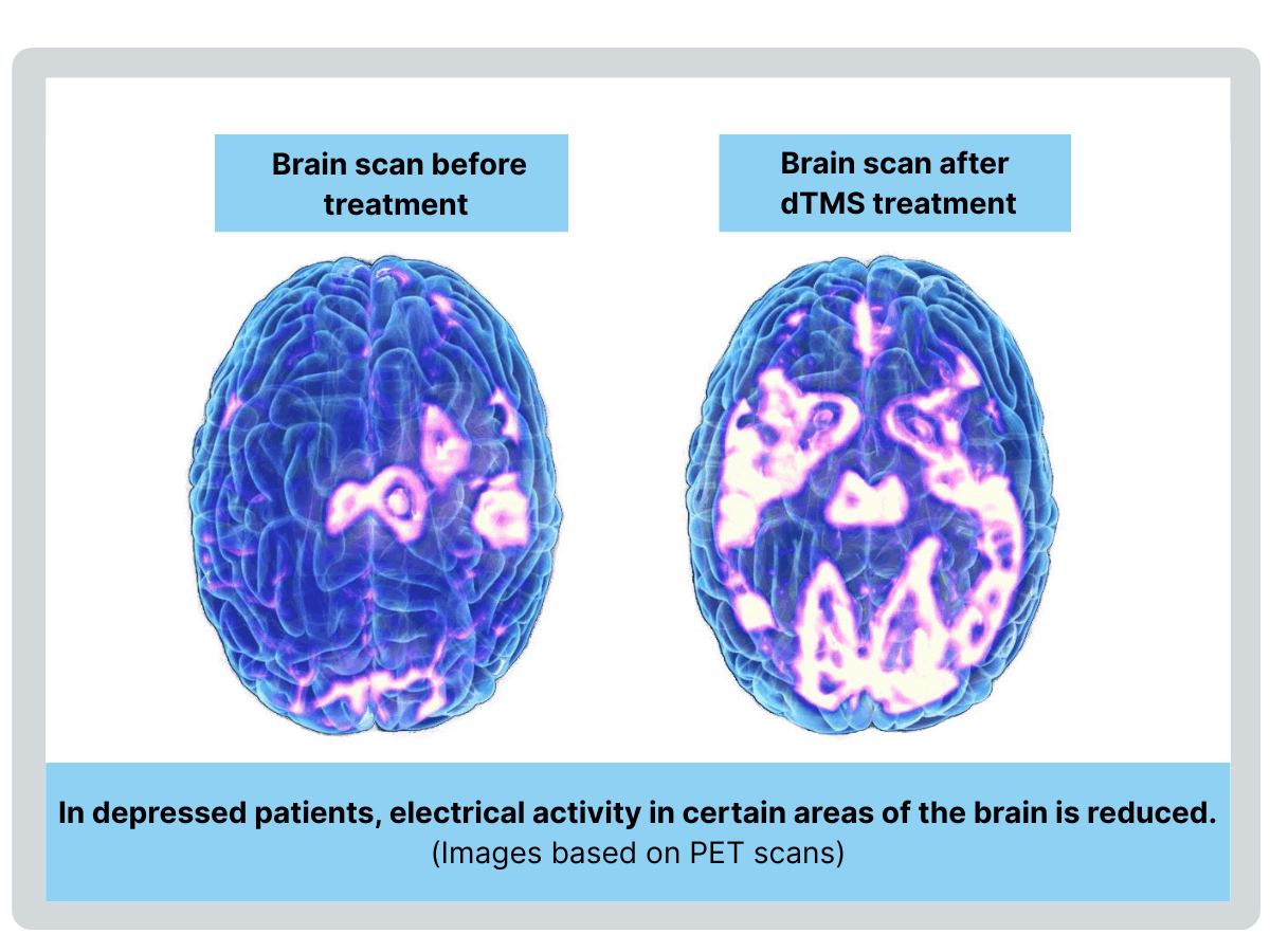 Image showing PET brain scans showing brain of depressed individual before and after dTMS treatment.