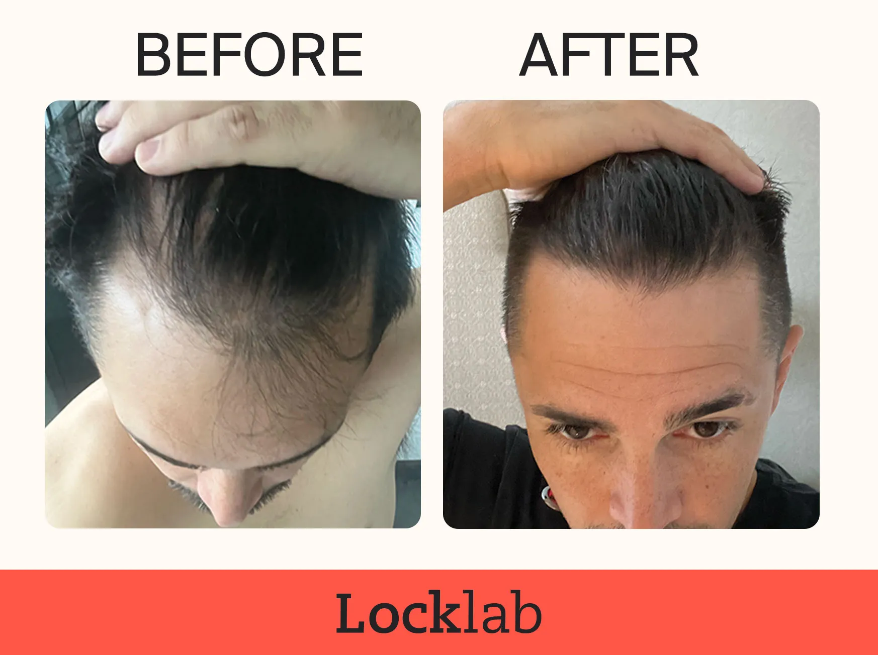 Locklab before and after photo stopping hair loss