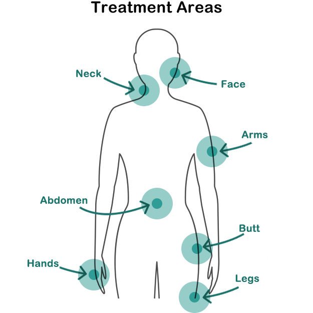 Morpheus8 Microneedling with radio frequency body chart of treatable areas