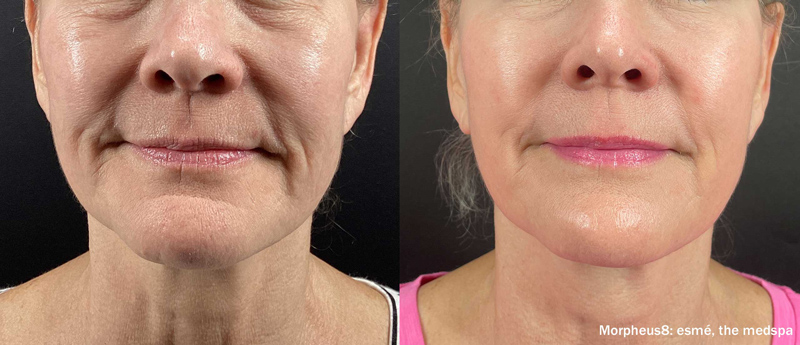 Before and after results on a woman's face from Morpheus8 Microneedling treatment in Lebanon TN