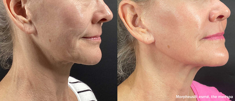 Before and after results on a woman's jowls and neck from Morpheus8 Microneedling treatment in Lebanon TN