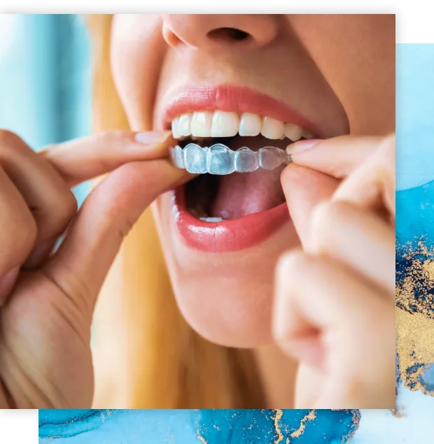 Woman putting in a clear aligner, Invisalign at Soda City Dentistry in Cayce, SC