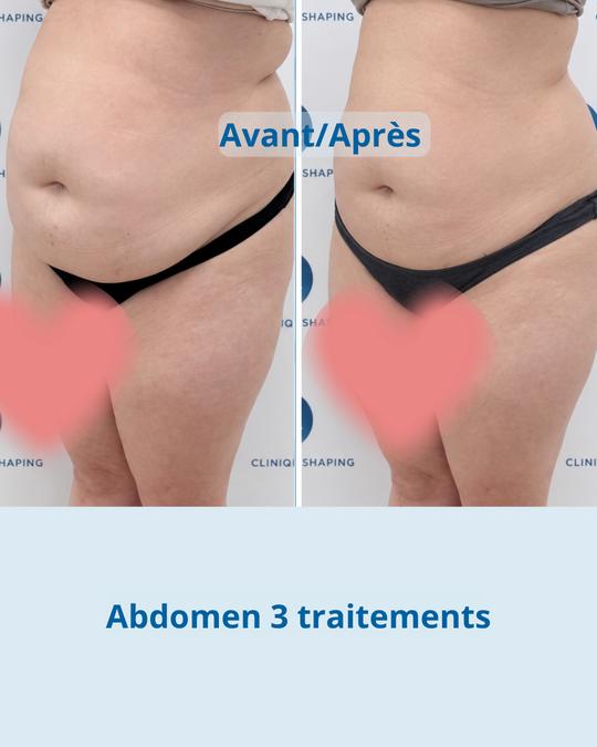 Avant et après : abdomen, 3 traitements
