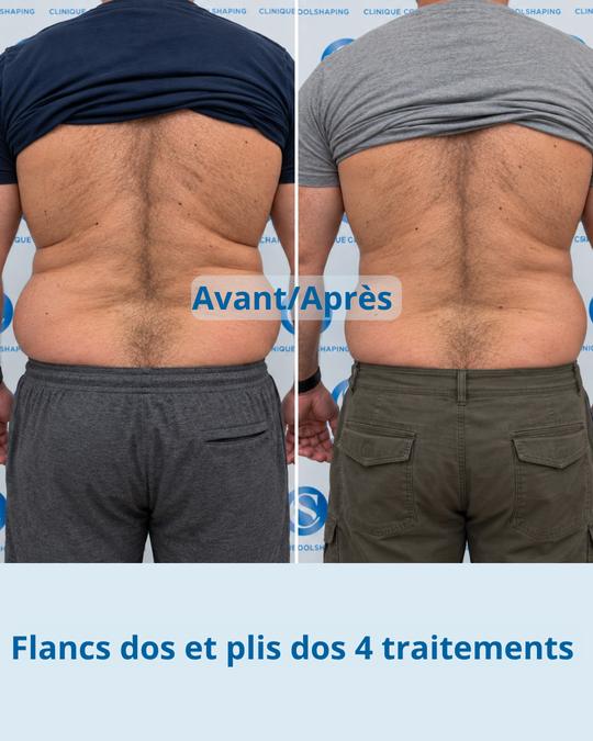 Avant et après : flancs et plis du dos, 4 traitements