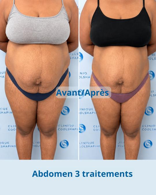 Avant et après : abdomen, 3 traitements