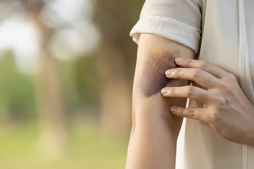 Assault Injury