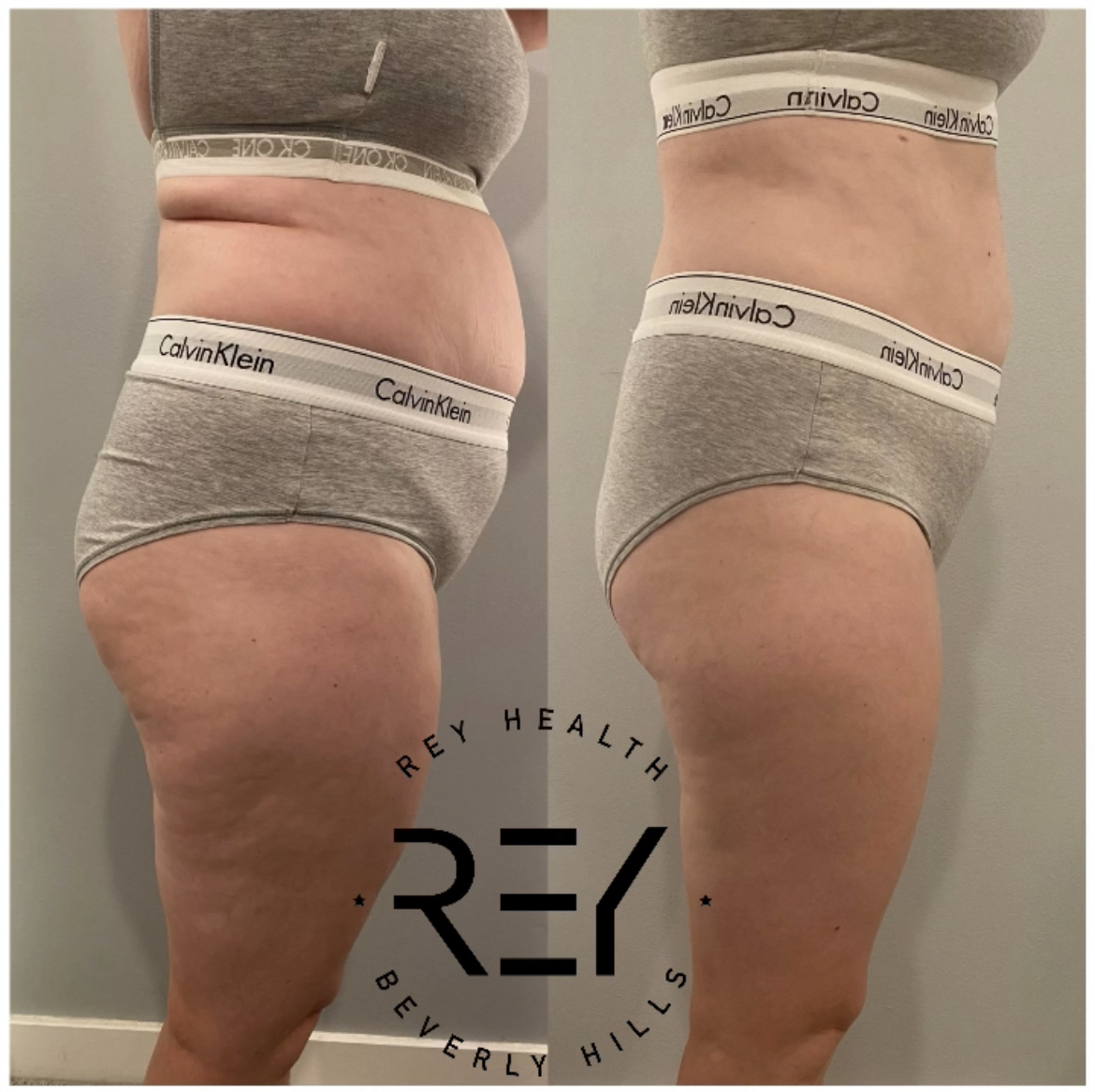 Body contouring client treatment image at ReyHealth