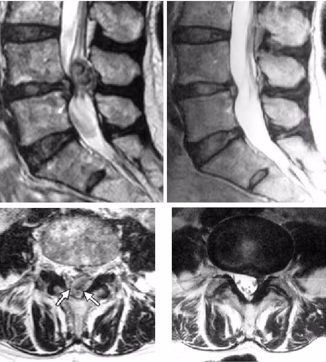 MRI foto van een lage rug