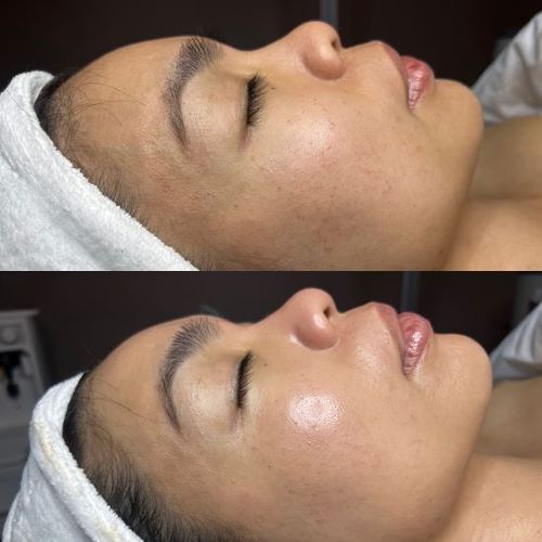Facial Near me Aesthetician Dermaplaning, DiamondGlow