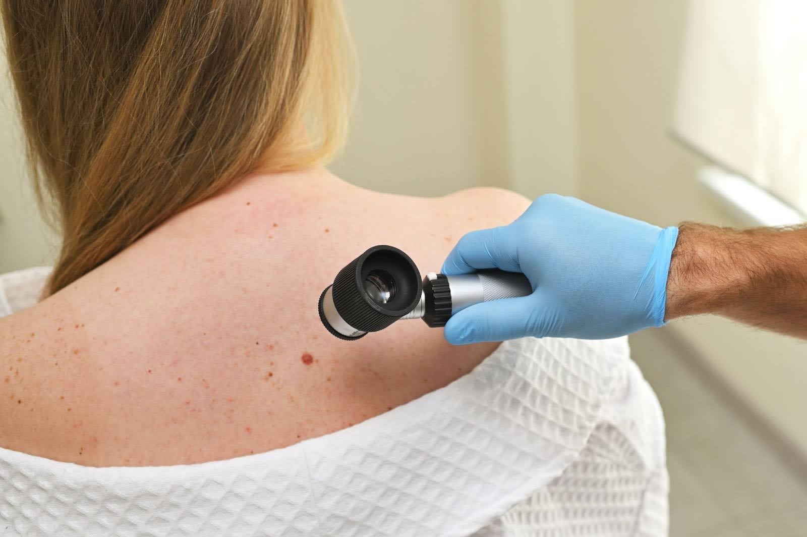 A dermatologist examining moles and birthmarks with a dermatoscope during a full-body skin screening.