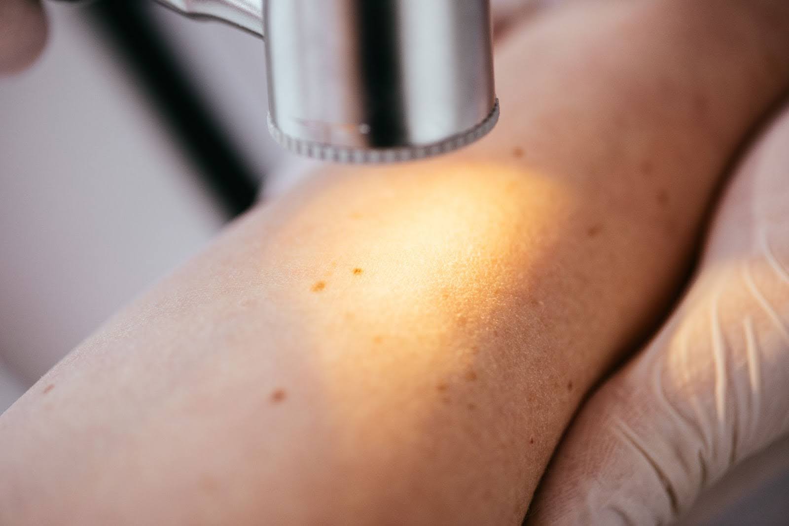 Close-up of a dermatoscope examining a mole on a patient’s hand with visible signs of melanoma.