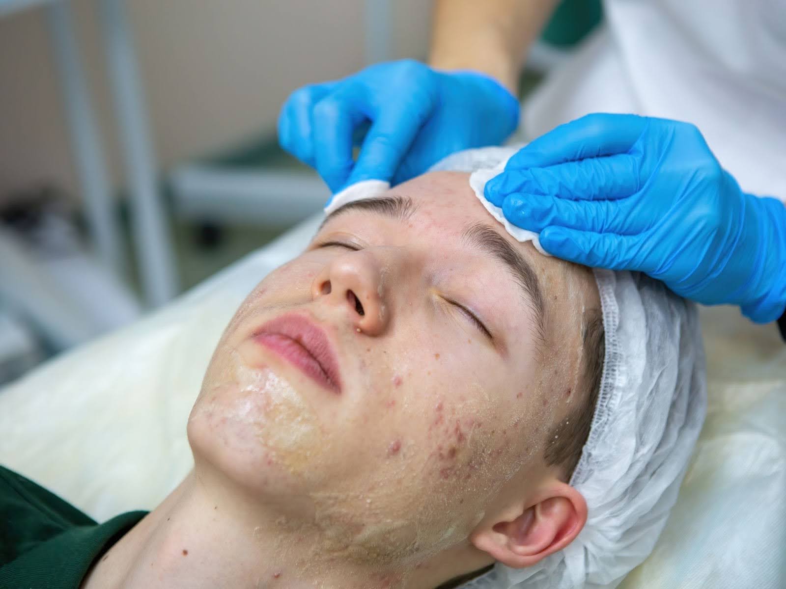 A teenage boy having his face cleansed by an esthetician before a microneedling treatment for acne.