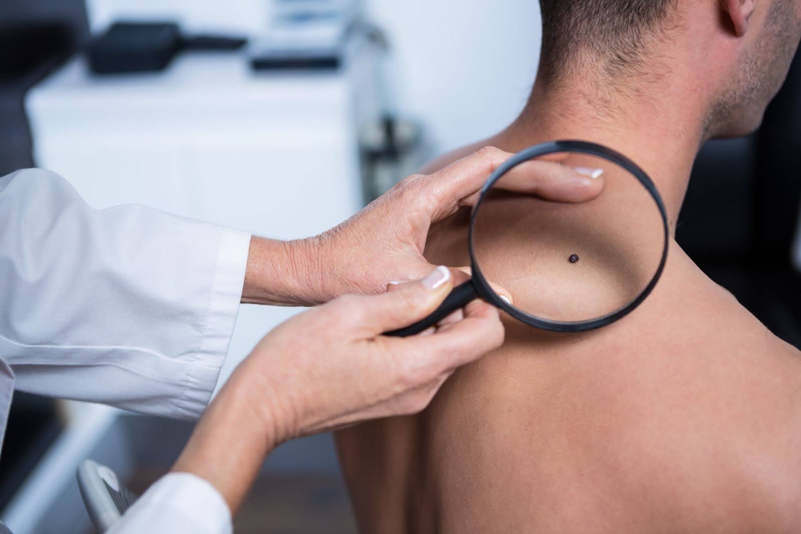 A dermatologist closely examines a skin mole with a magnifying glass.
