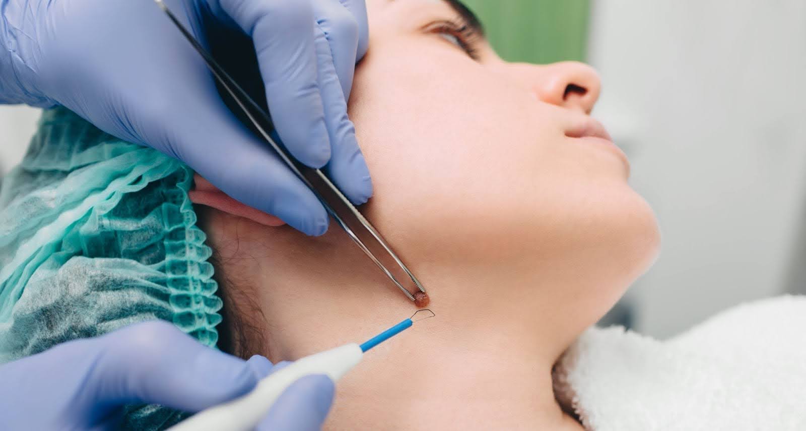 Close-up of a mole removal procedure on the patient’s neck using the radio wave electrocoagulation method.
