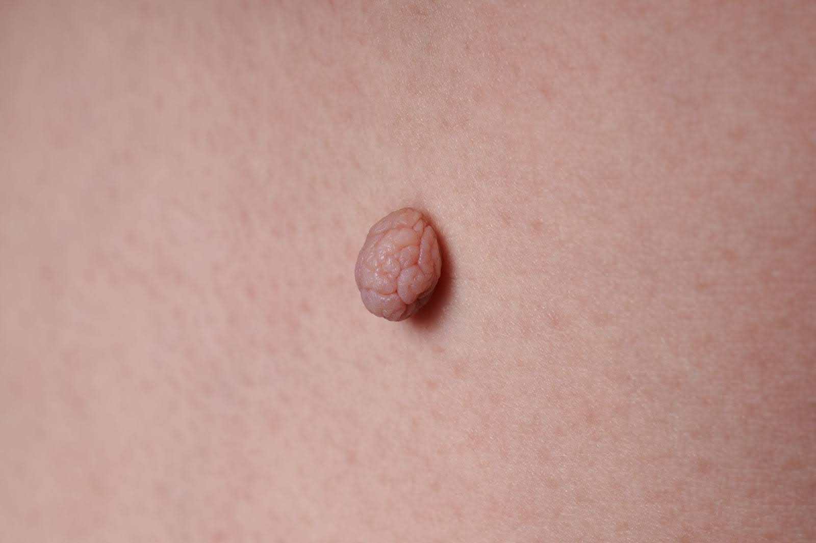 Close-up of a large, round papilloma, a benign skin mole.