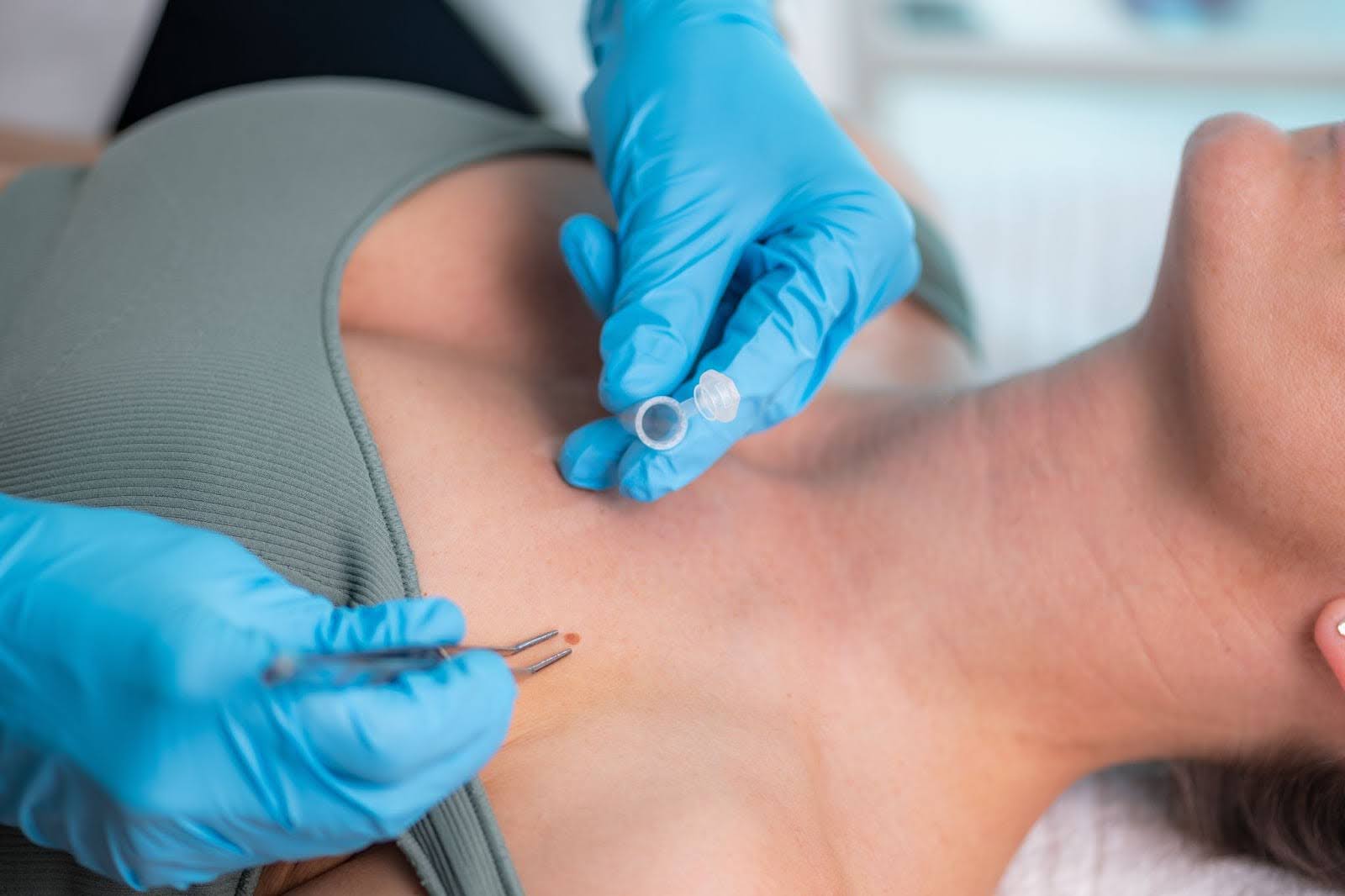 Close-up of dermatologist extracting a lesion for diagnostic care.