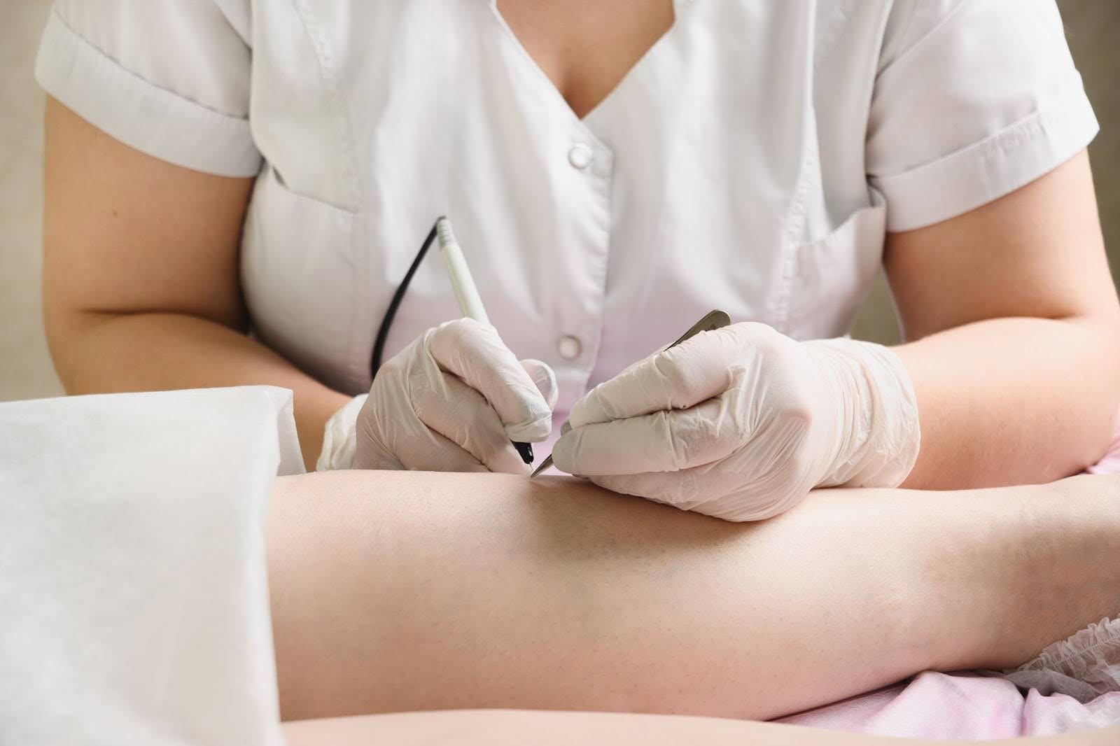 Professional electrolysis hair removal performed on a woman’s legs.