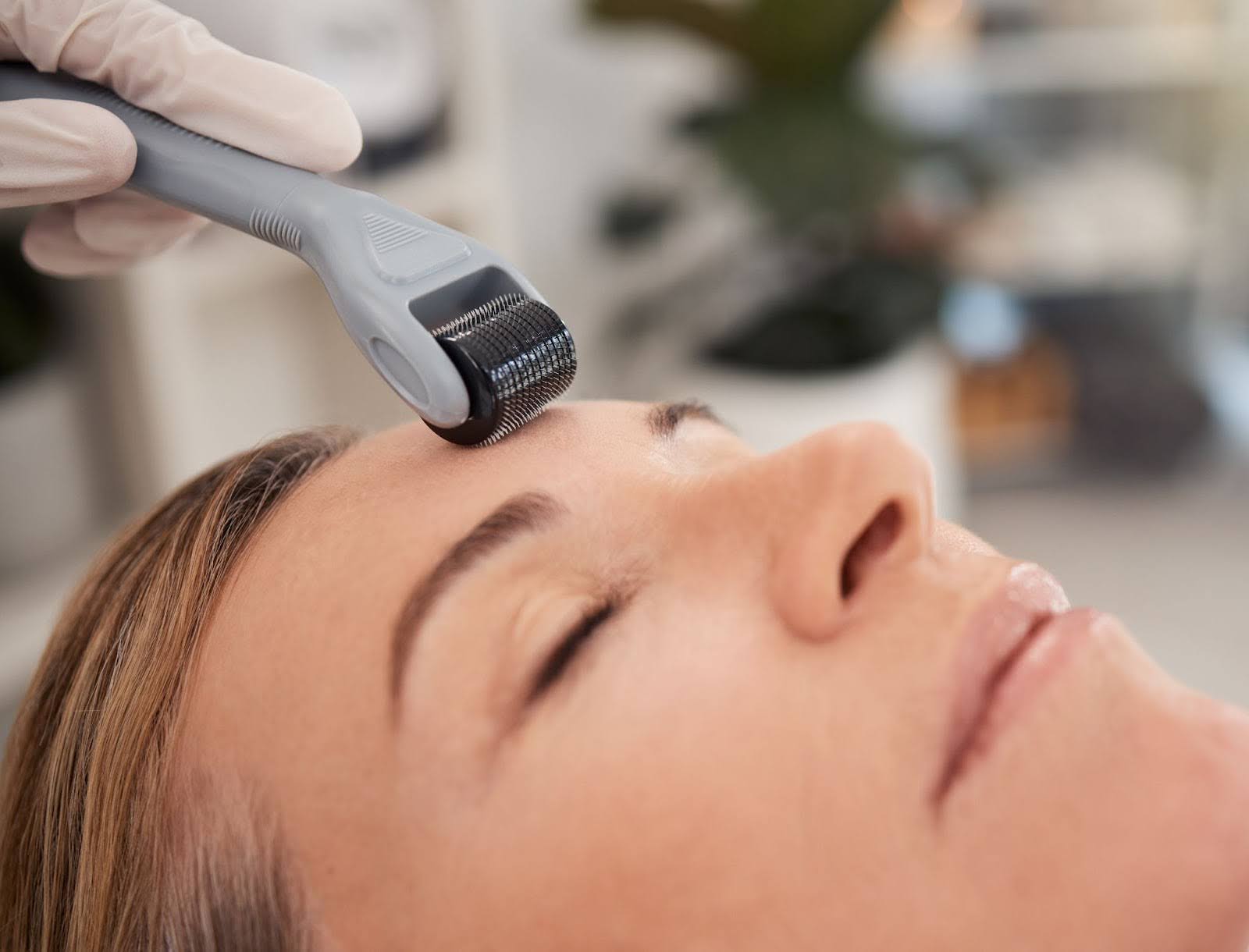 Woman undergoing dermaroller procedure for smoother, firmer skin.