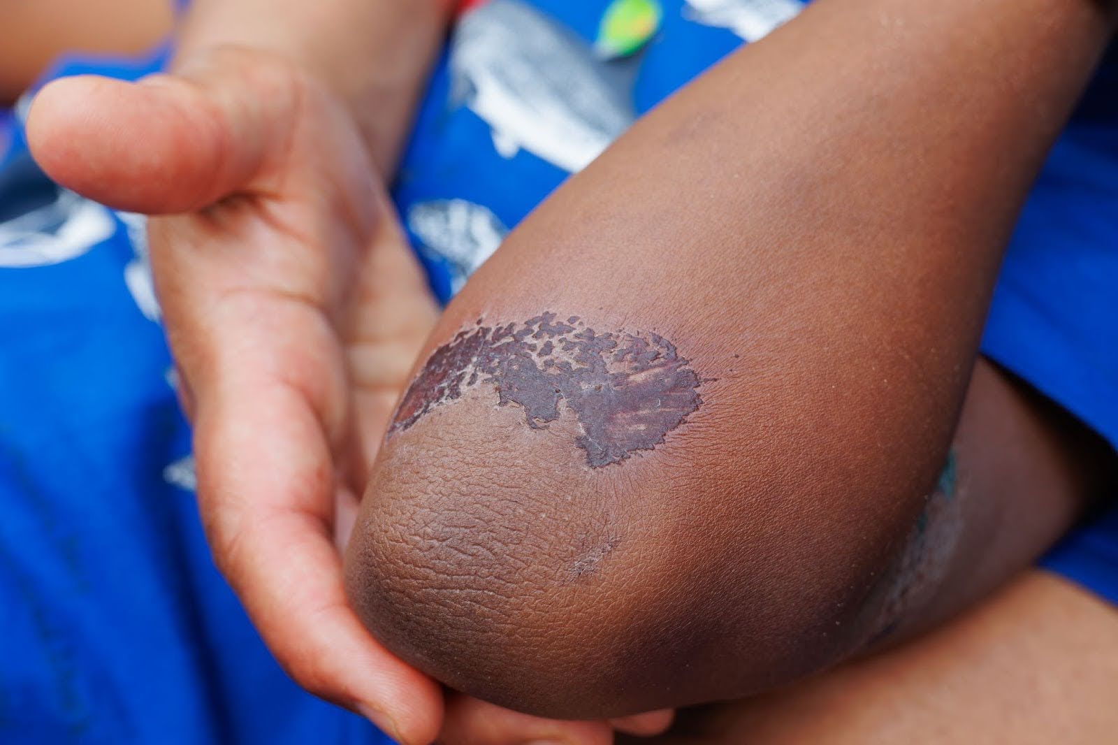  Closeup on a discolored lesion on a child’s elbow.