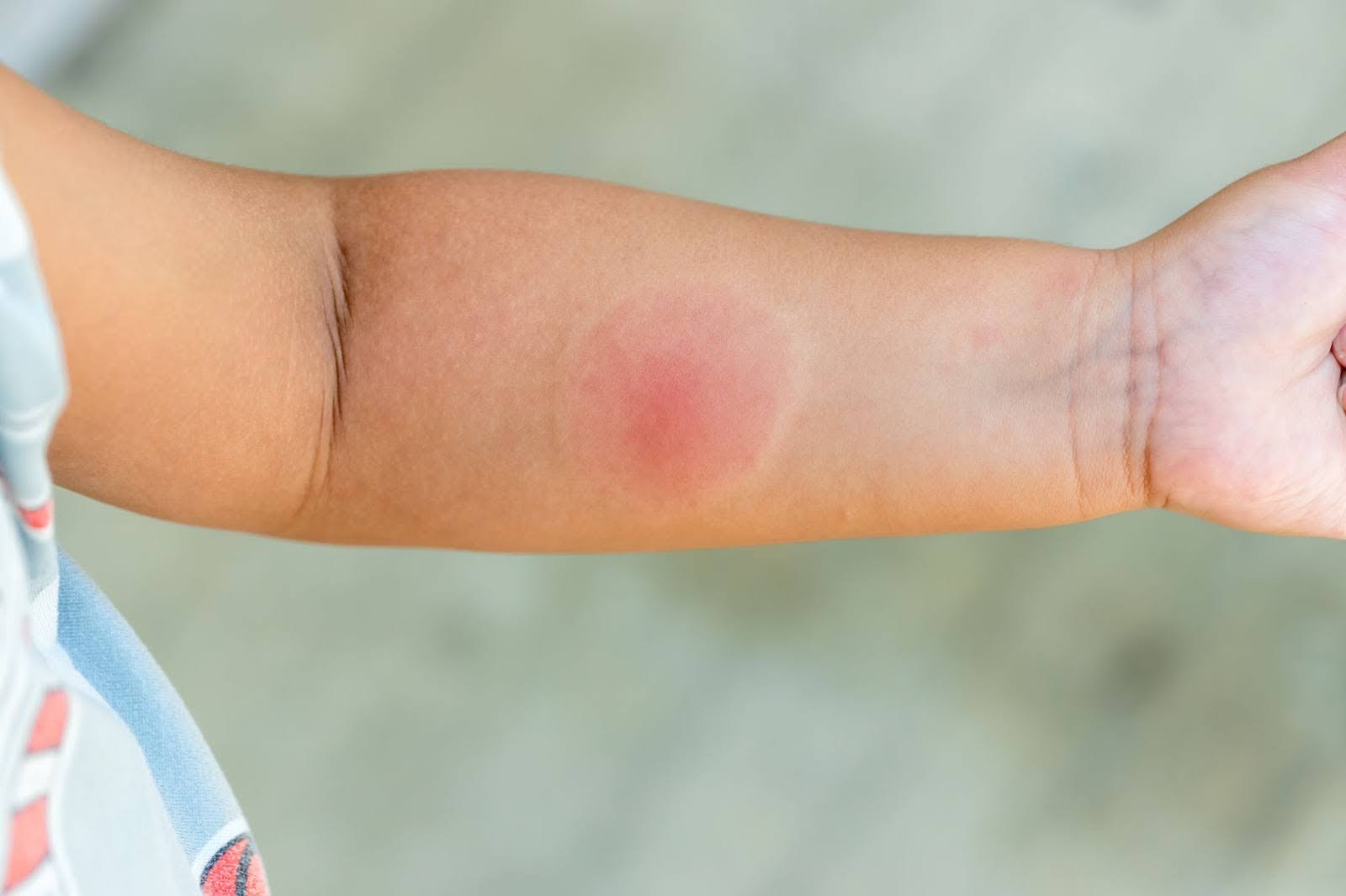 An irritated skin lesion on a baby’s arm.