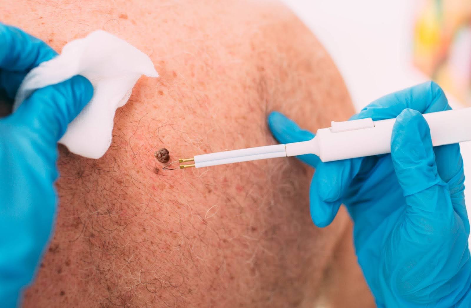 Close-up view of a mole removal procedure on a patient’s back.