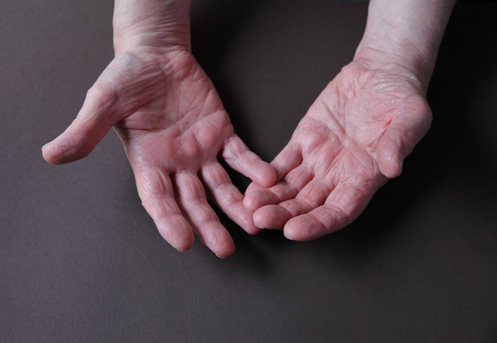 Close-up of an older man’s sweaty hands on a dark background.