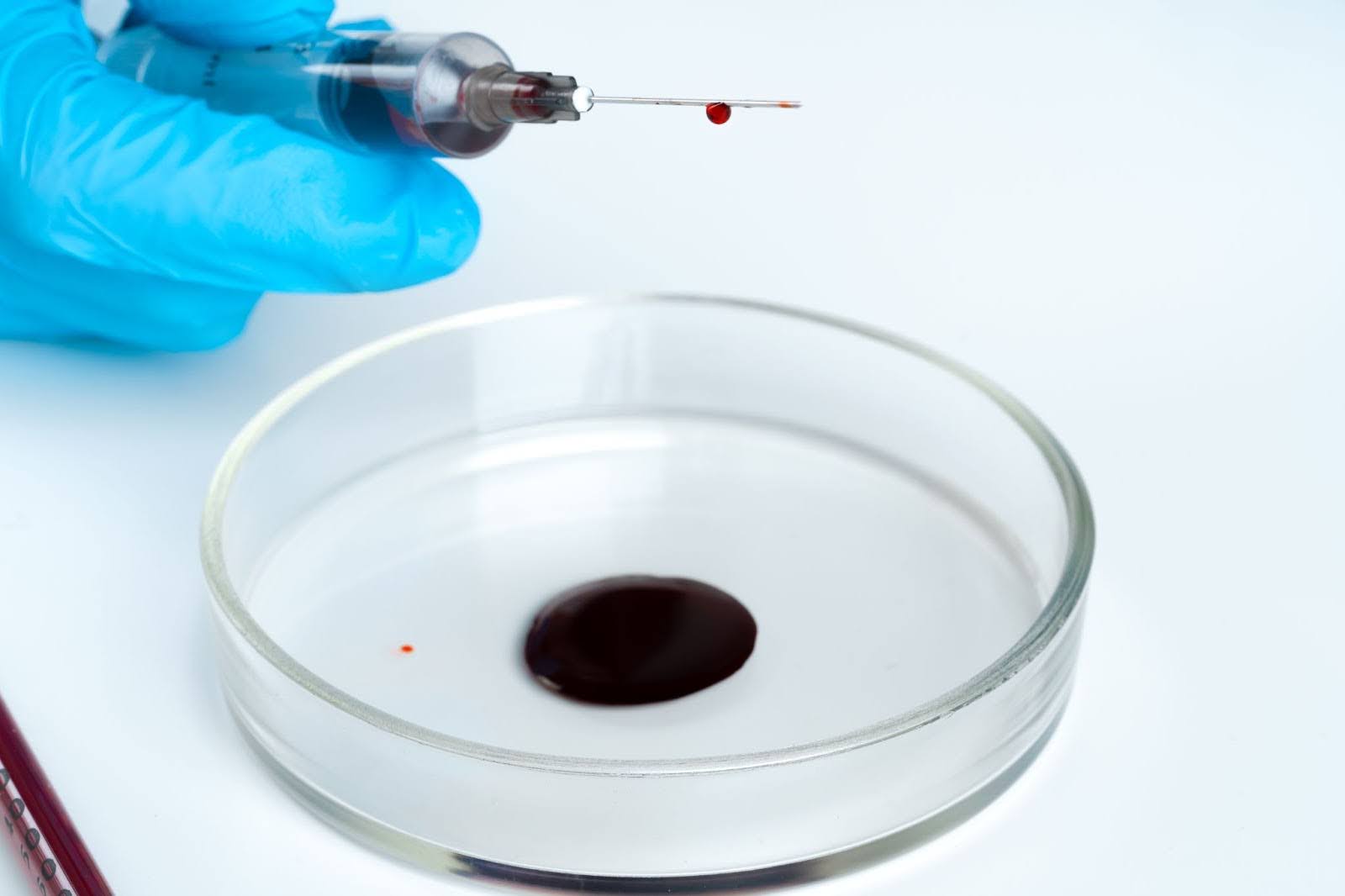 Blood sample in a syringe and a clear bowl before processing for platelet therapy.