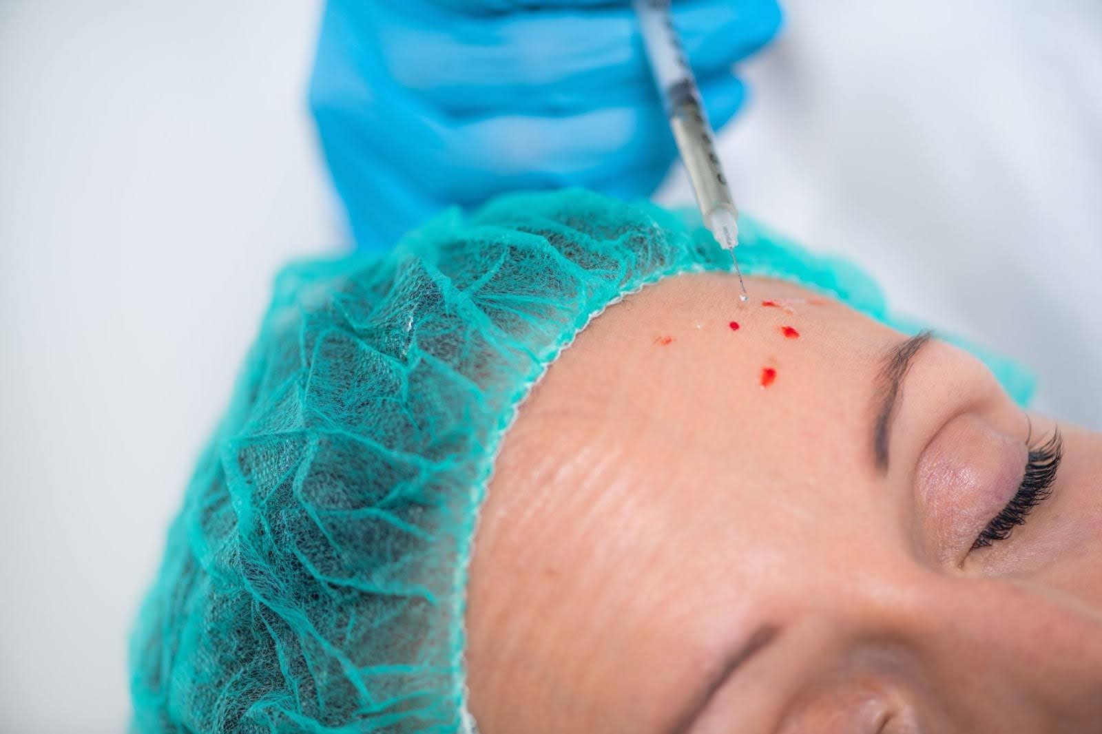 Platelet-rich plasma facial injection targeting skin texture and tone improvement.
