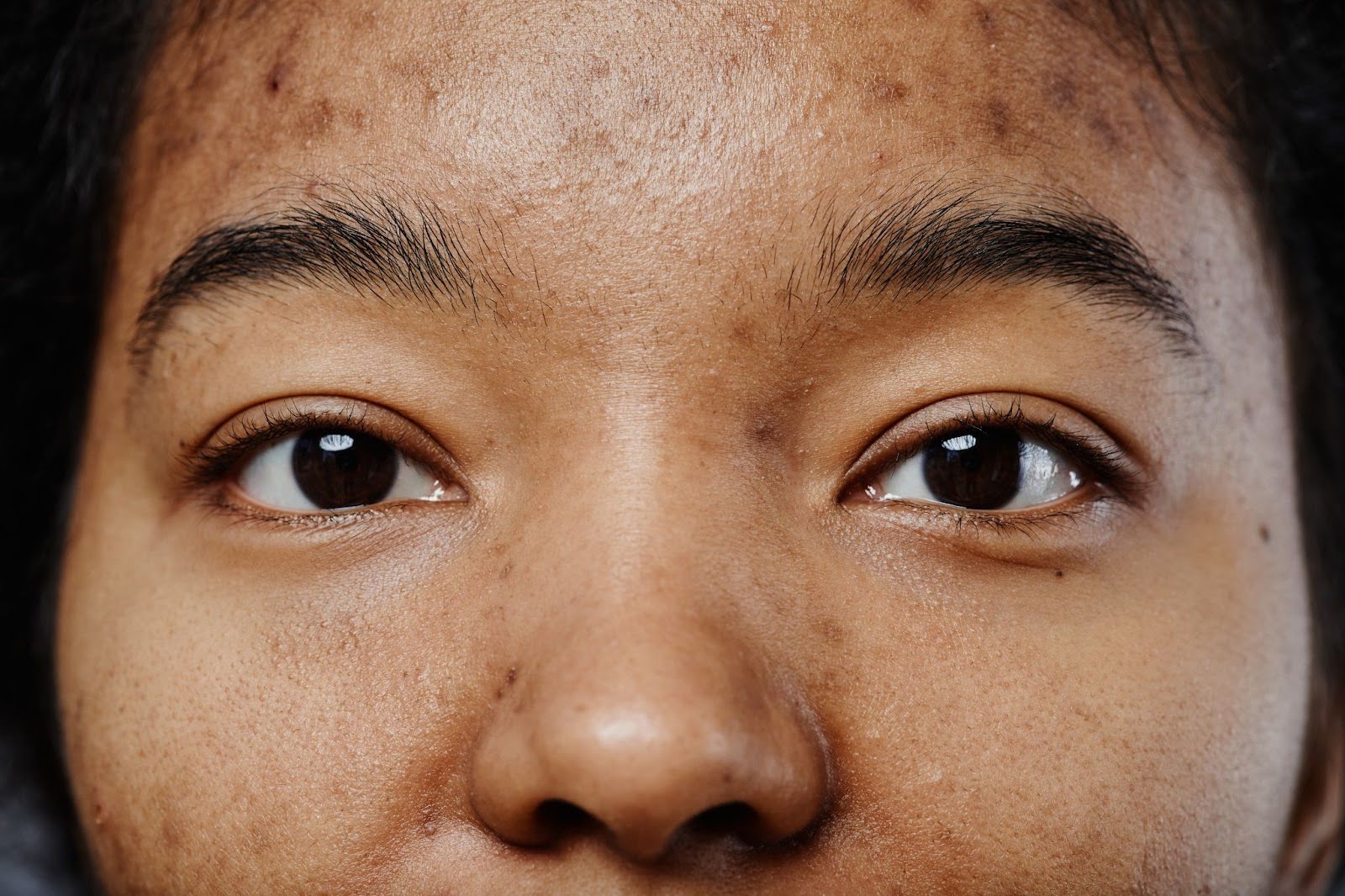 Post-acne hyperpigmentation on a young Black woman’s face.
