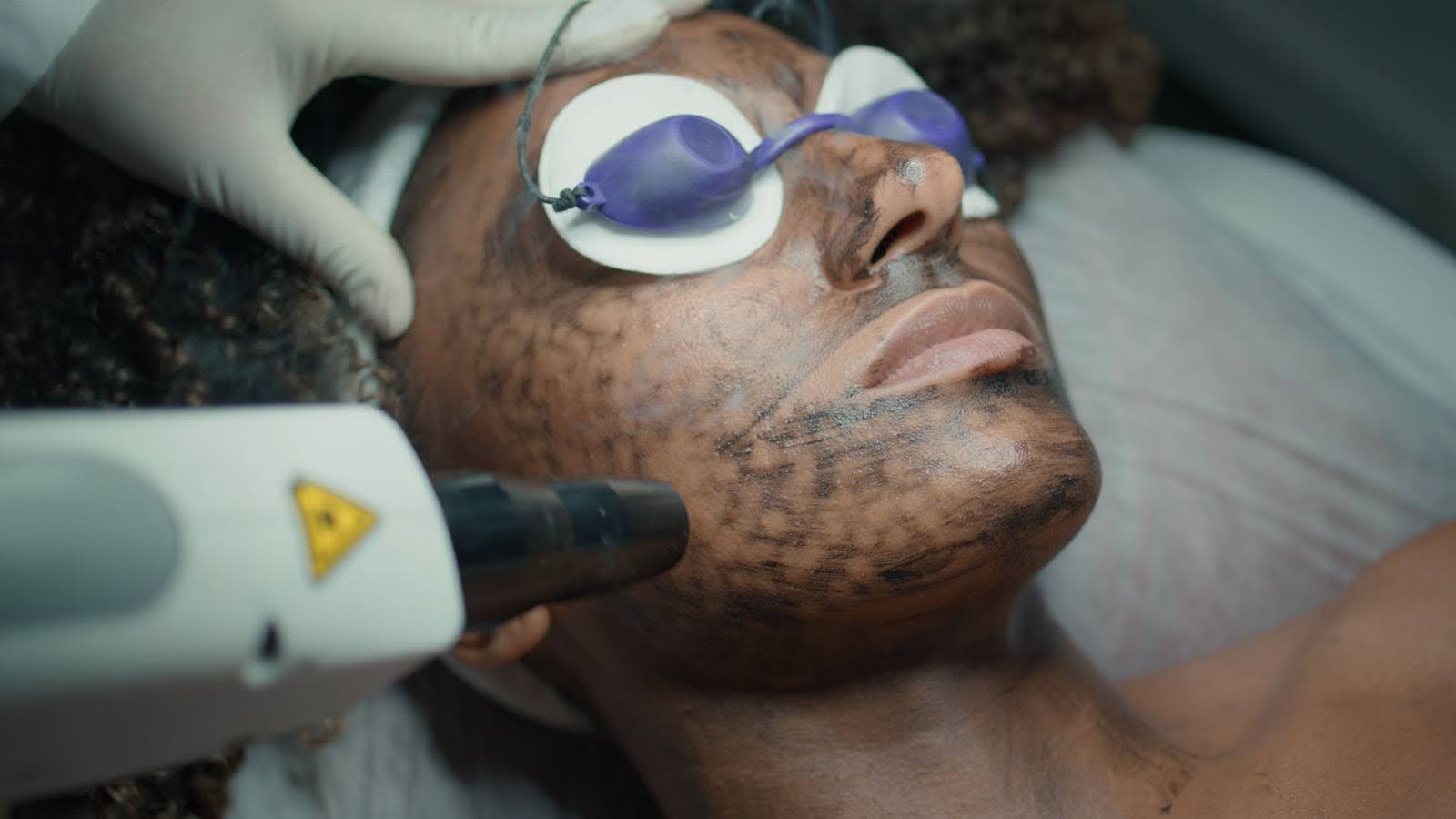 Laser facial procedure addressing hyperpigmentation and uneven skin tone.