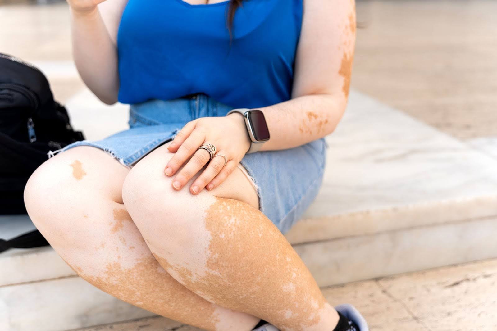 Cropped outdoor shot of a woman showing visible depigmented skin patches caused by vitiligo.