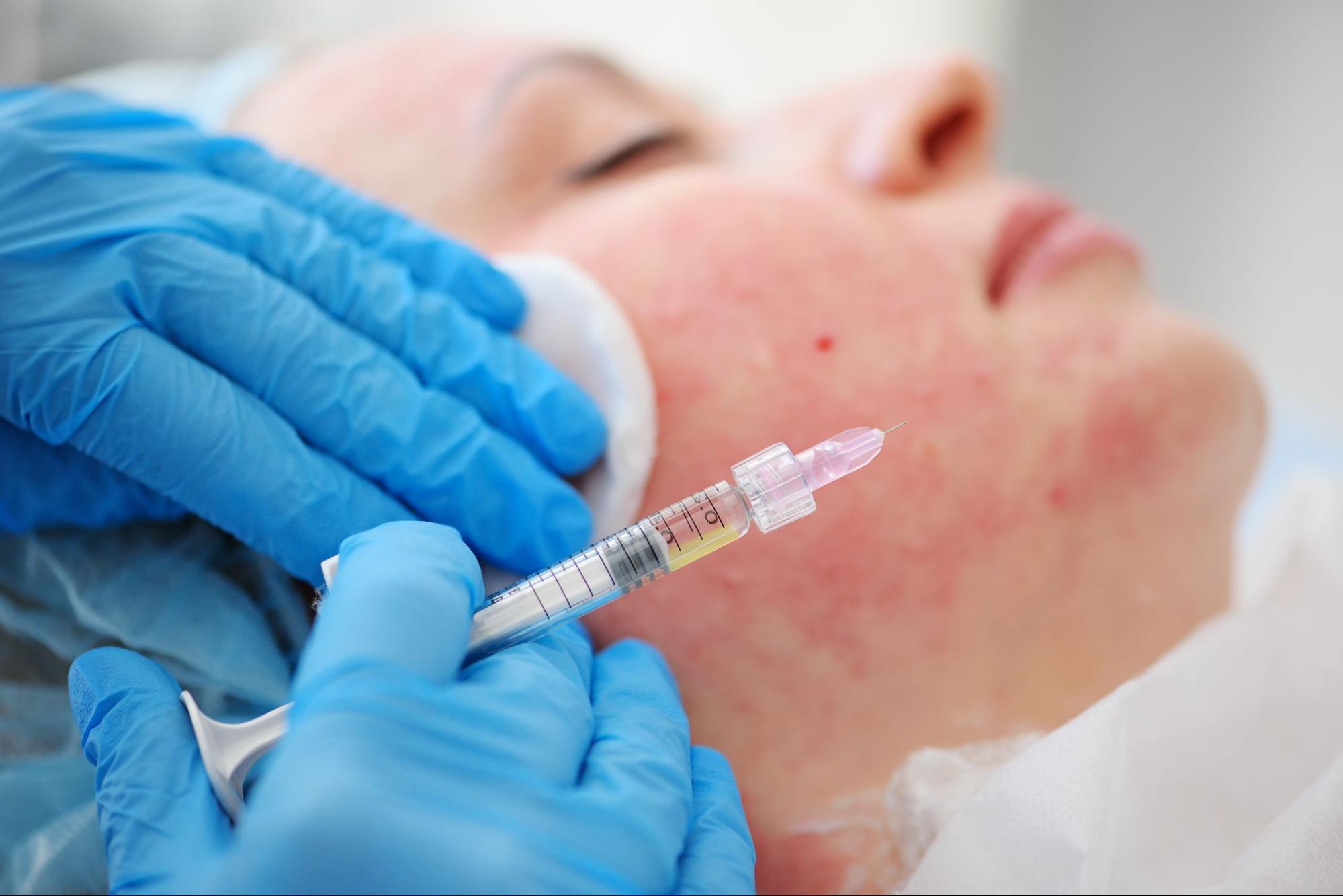 PRP injection procedure to improve acne scarring and skin texture.