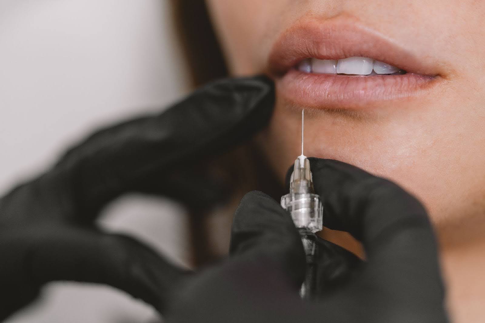 Cropped view of an aesthetic expert performing a lip filler injection on a woman’s lips.