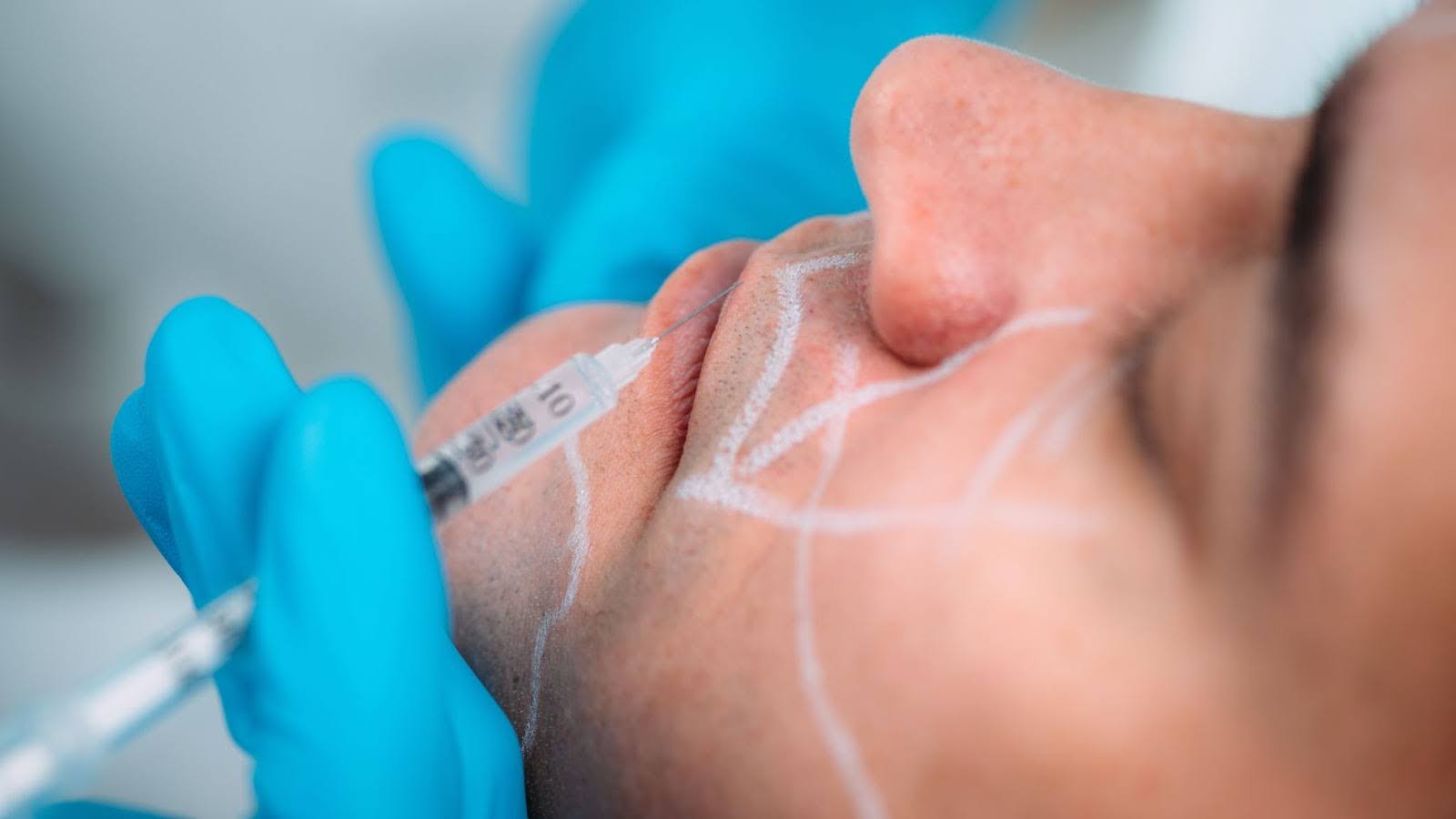 Close-up of a facial-mapped man receiving dermal filler treatment to soften pronounced facial lines.