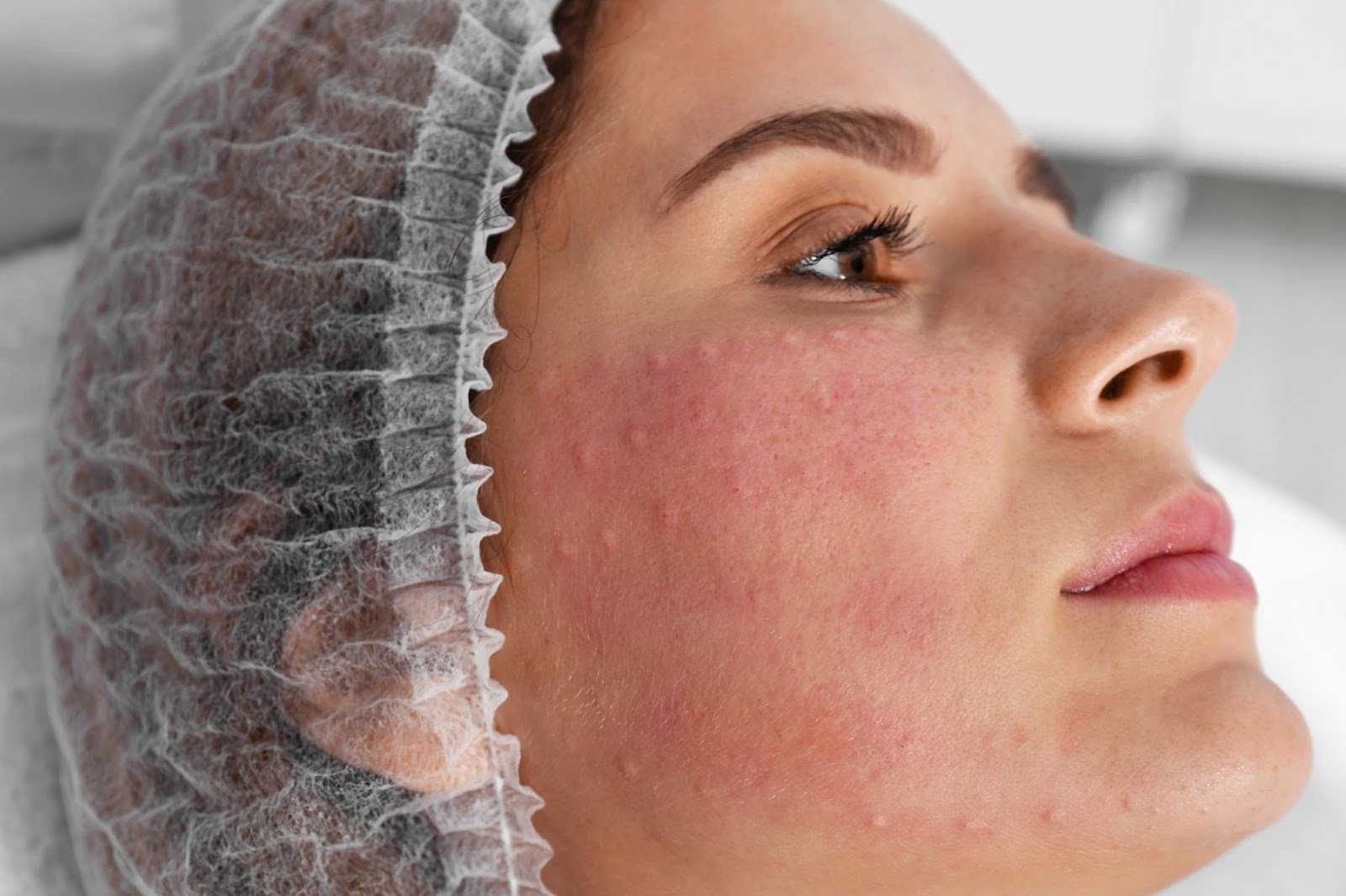 Woman with visible rosacea redness on her cheeks awaiting a facial skin treatment procedure