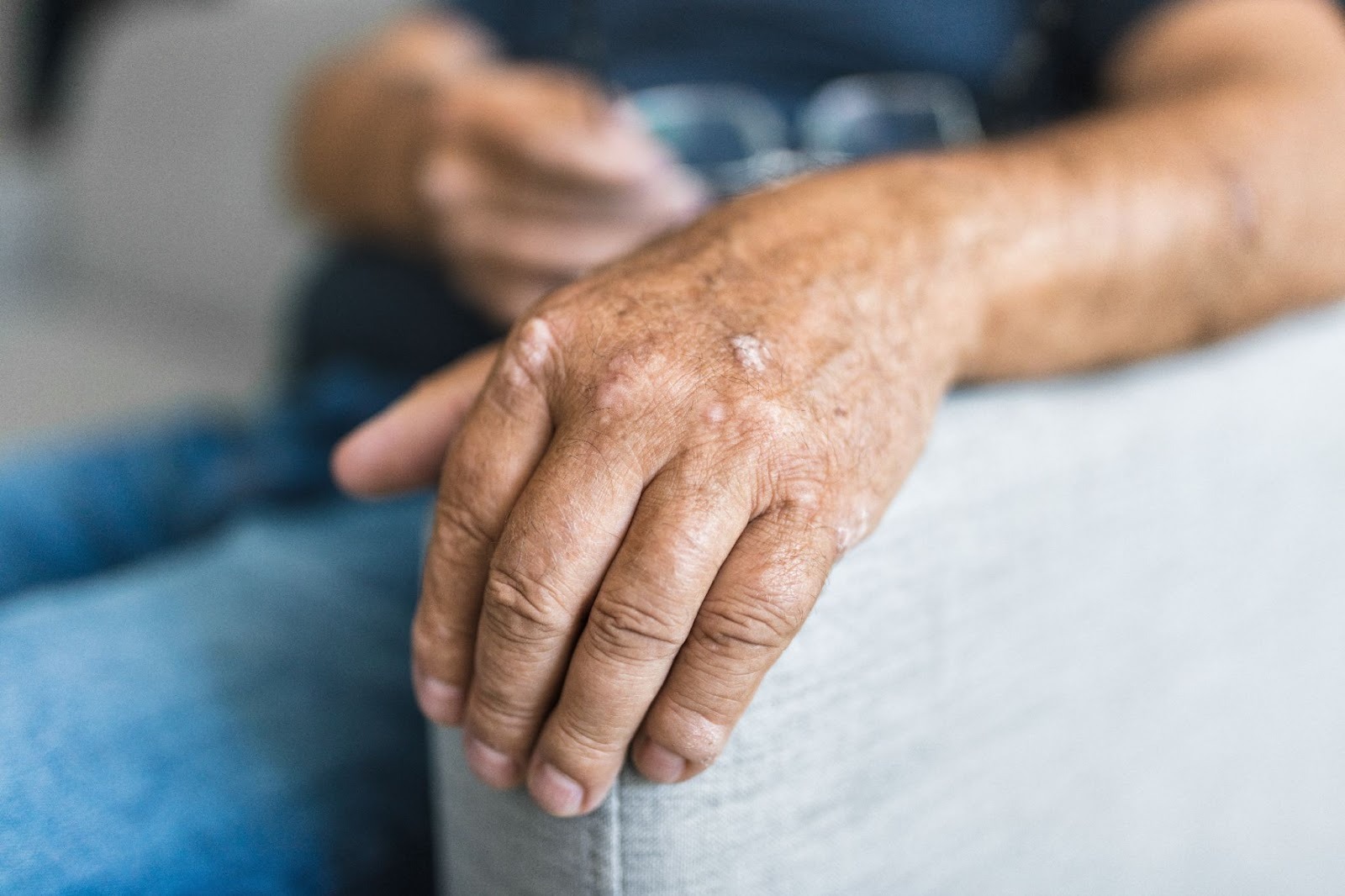 Close-up of an older man's hand with psoriasis plaques