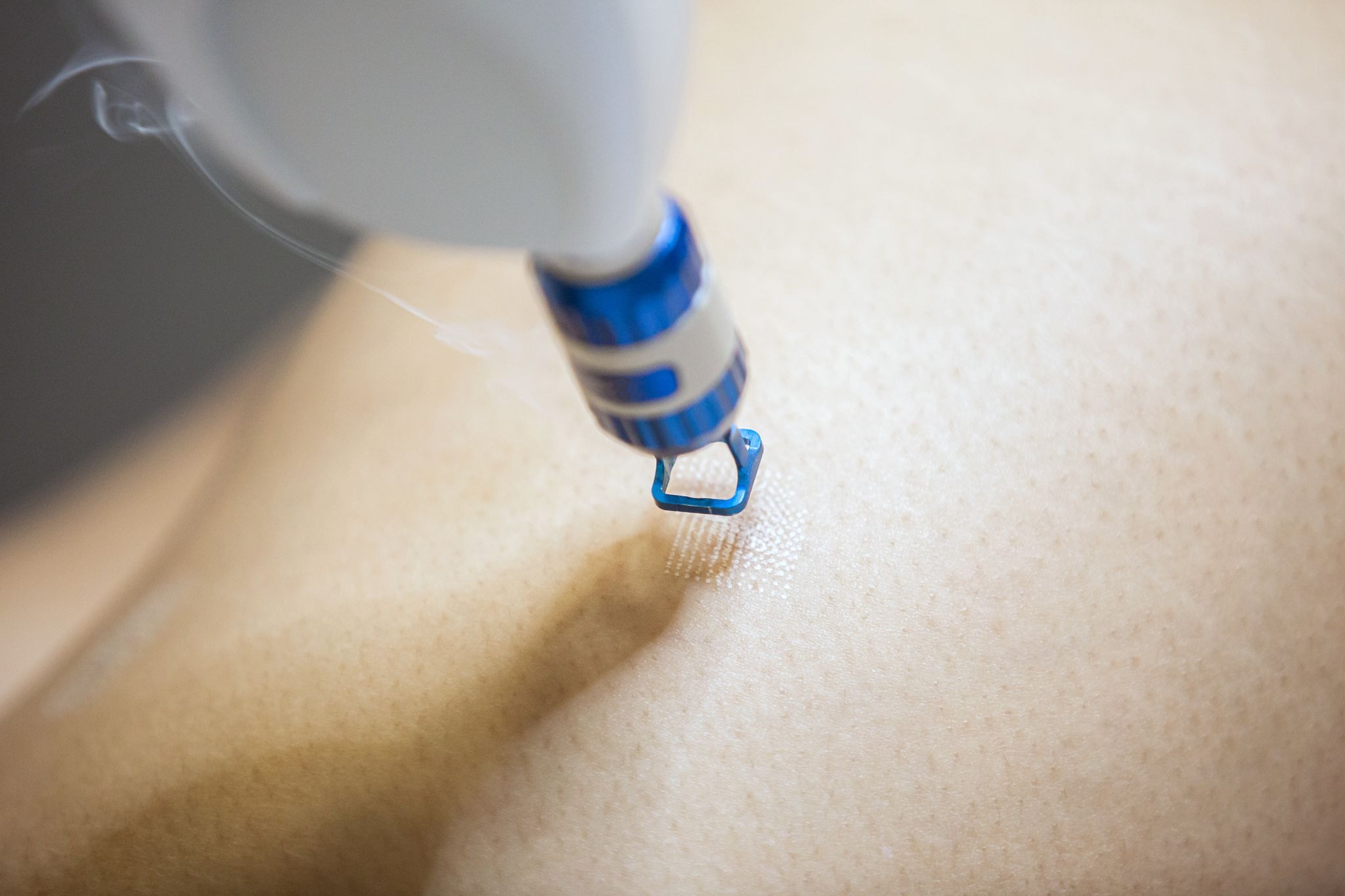 Close-up of laser treatment for scar removal