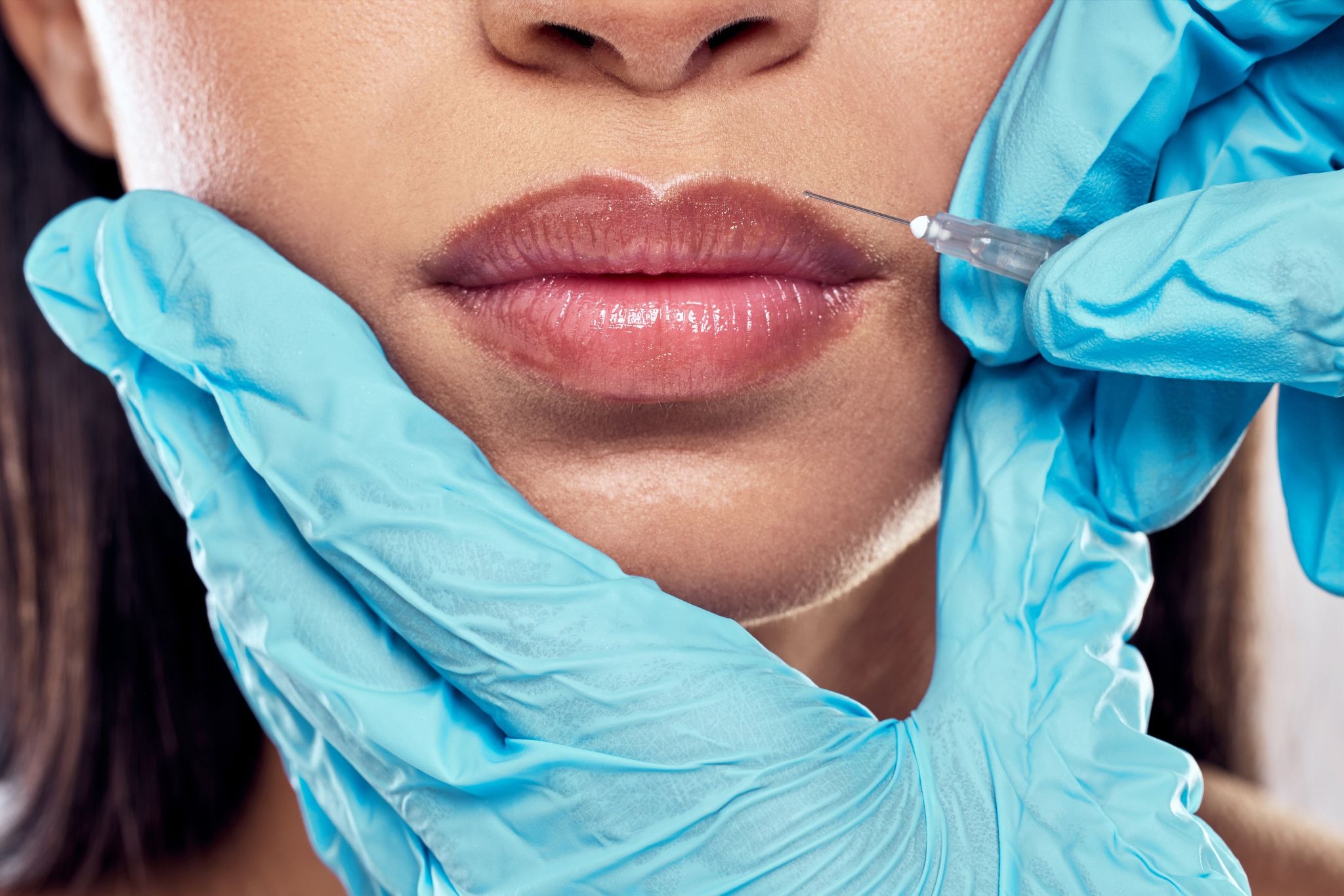 Close-up of a female patient receiving lip filler injections