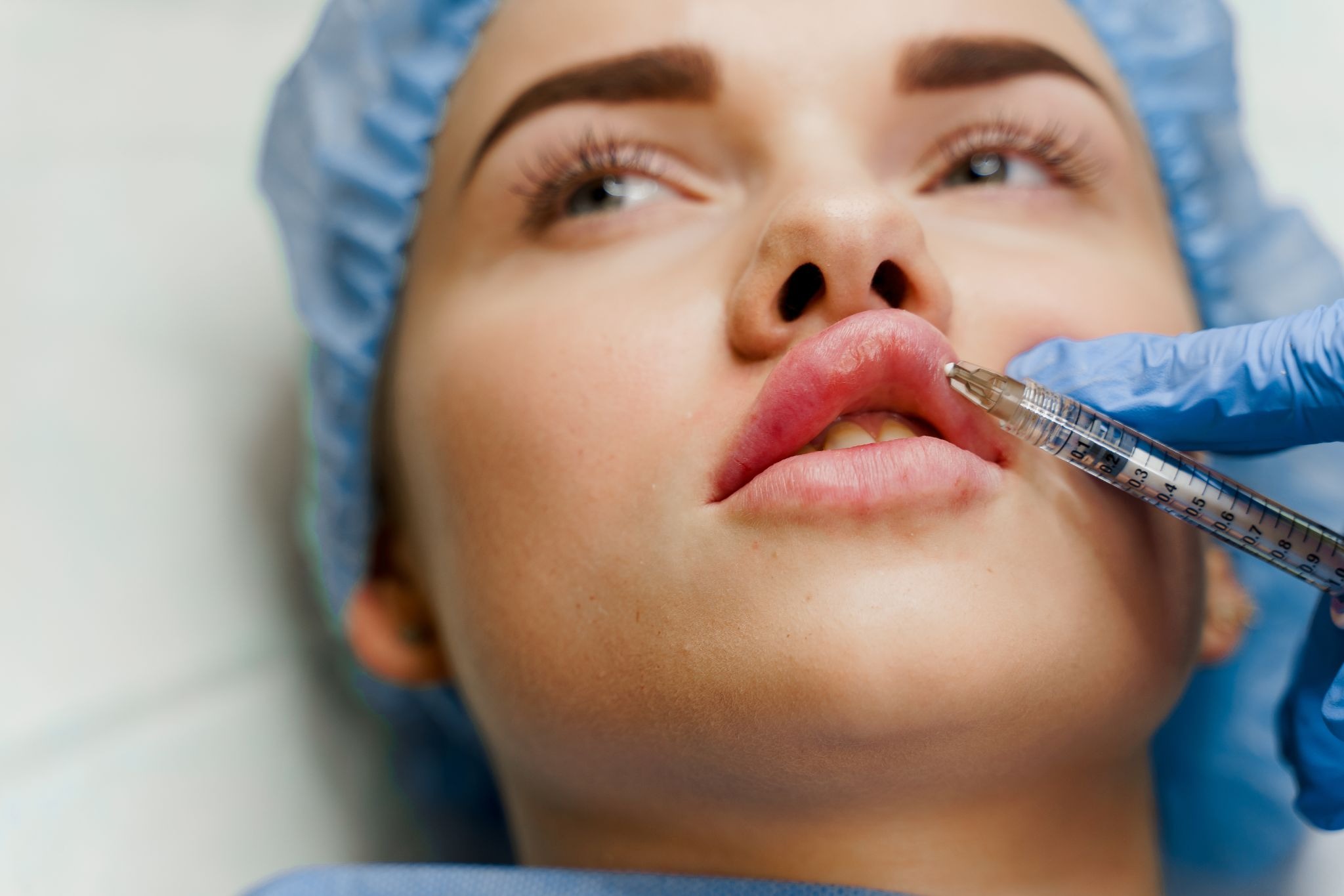 Close-up of a female patient receiving a dermal filler beneath her upper lip