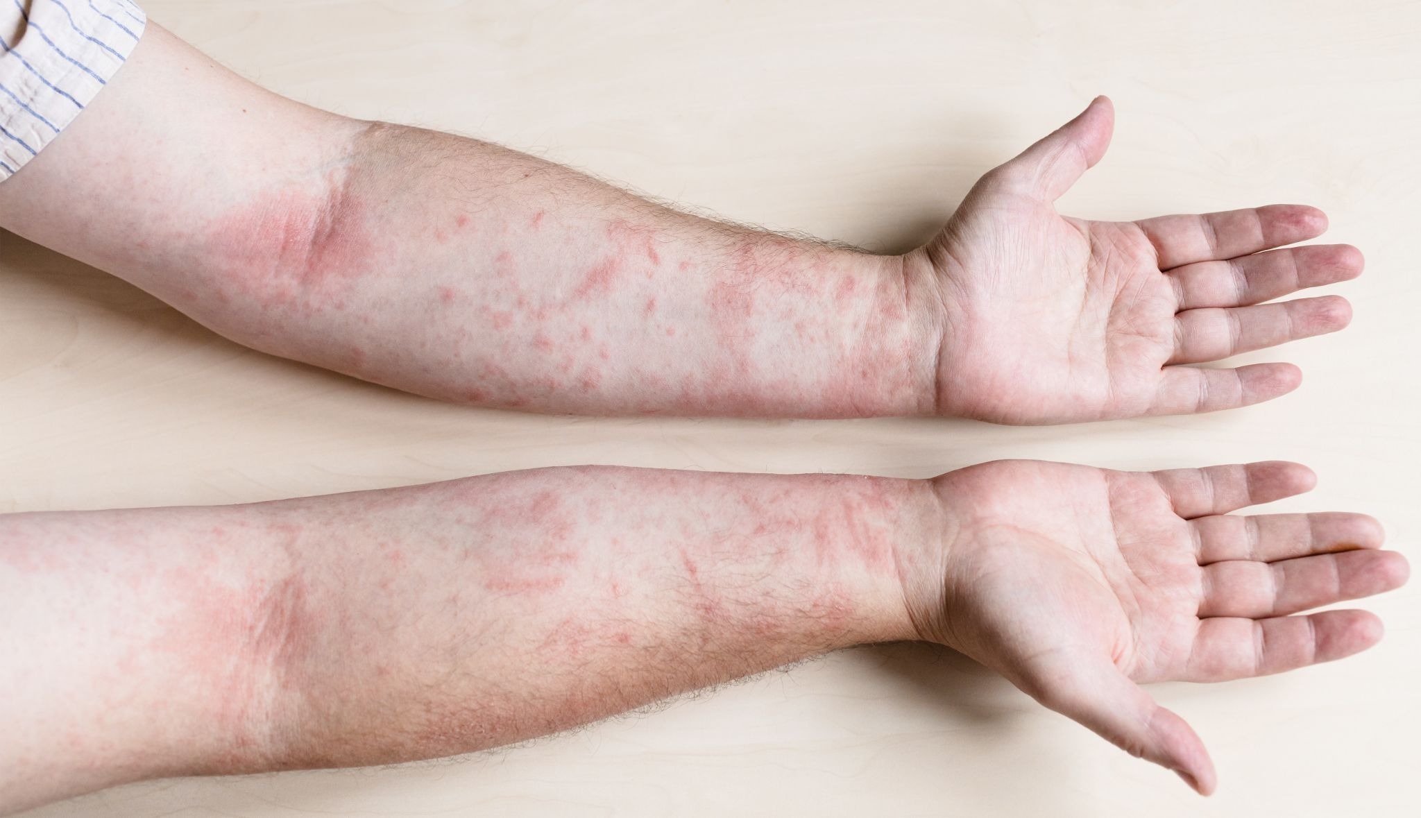 Inflamed skin on arms showing redness and irritation consistent with eczema flare-ups