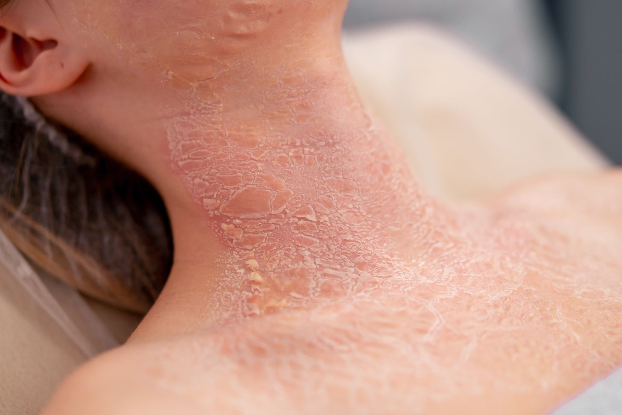 Close-up of irritated neck skin with redness, crusting, and peeling associated with inflammatory skin disease