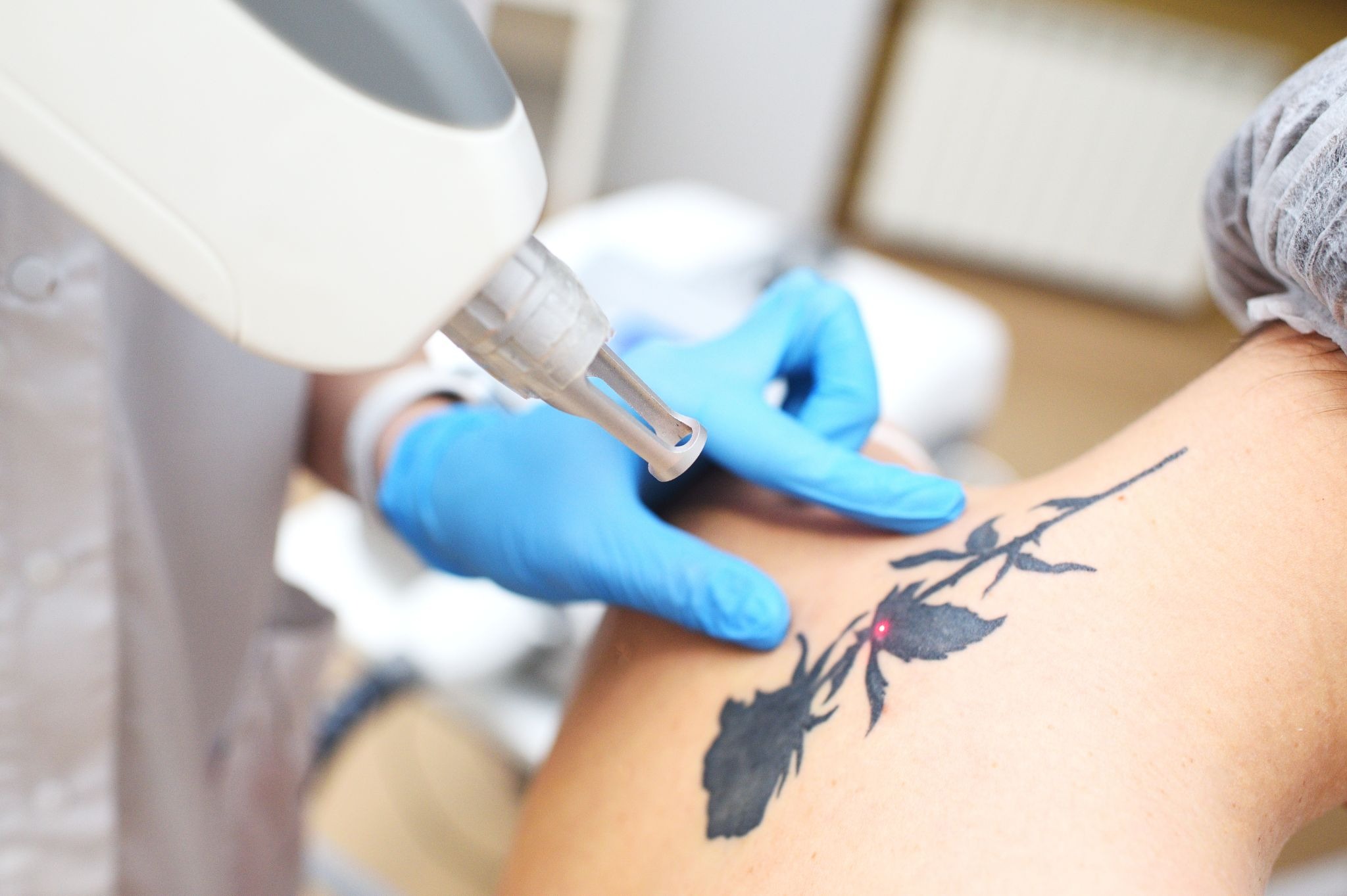 Close-up of laser tattoo removal on a woman’s nape